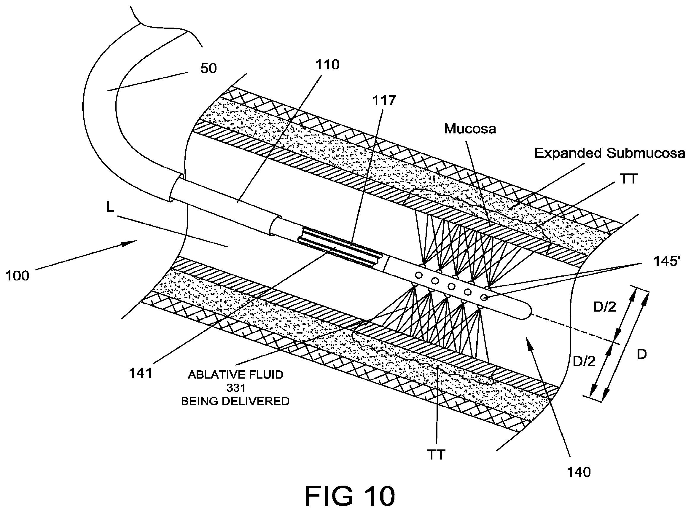 Patent US12396777 Figure 10 – Ablation systems, devices and methods for the treatment of tissue