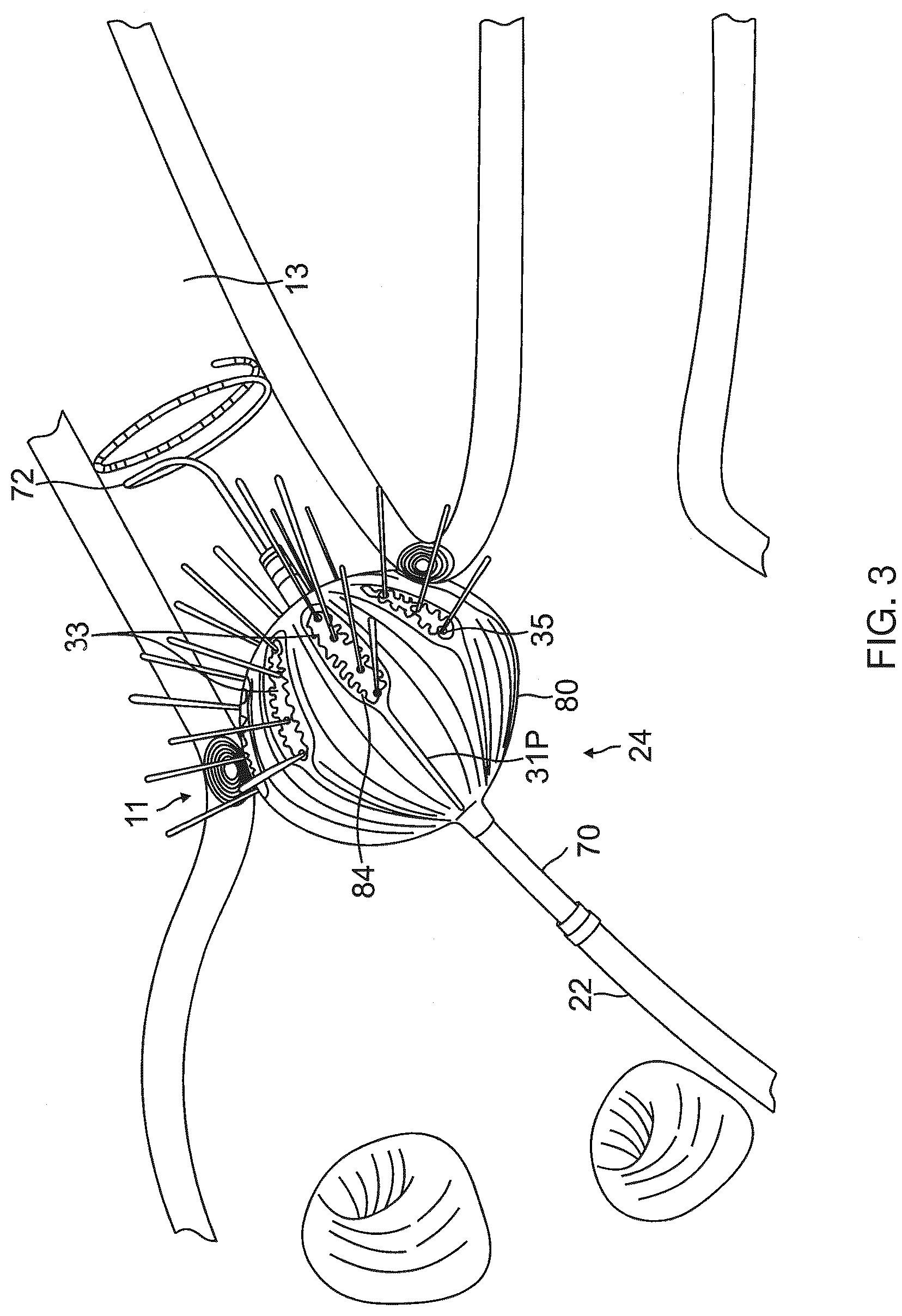 Patent US12396790 Figure 3 – Temperature controlled short duration ablation with multiple electrodes