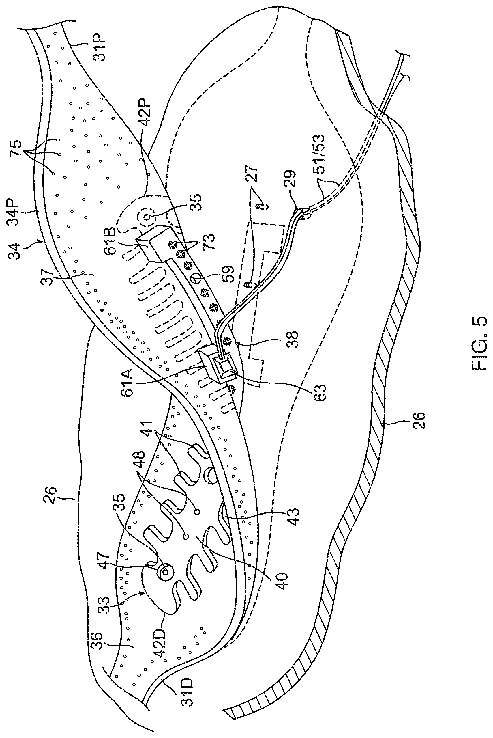 Patent US12396790 Figure 5 – Temperature controlled short duration ablation with multiple electrodes