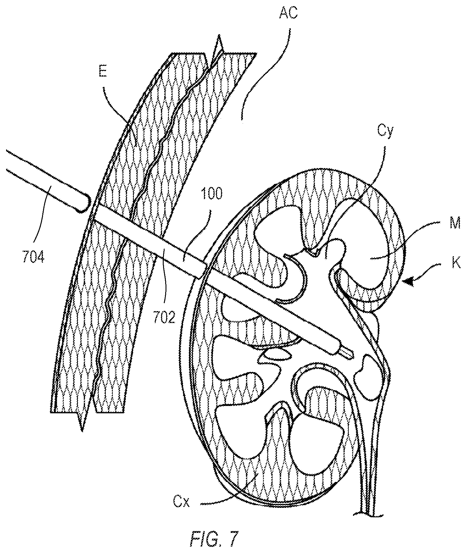 Patent US12396792 Figure 7 – Nephroscope with flexible and articulatable distal portion