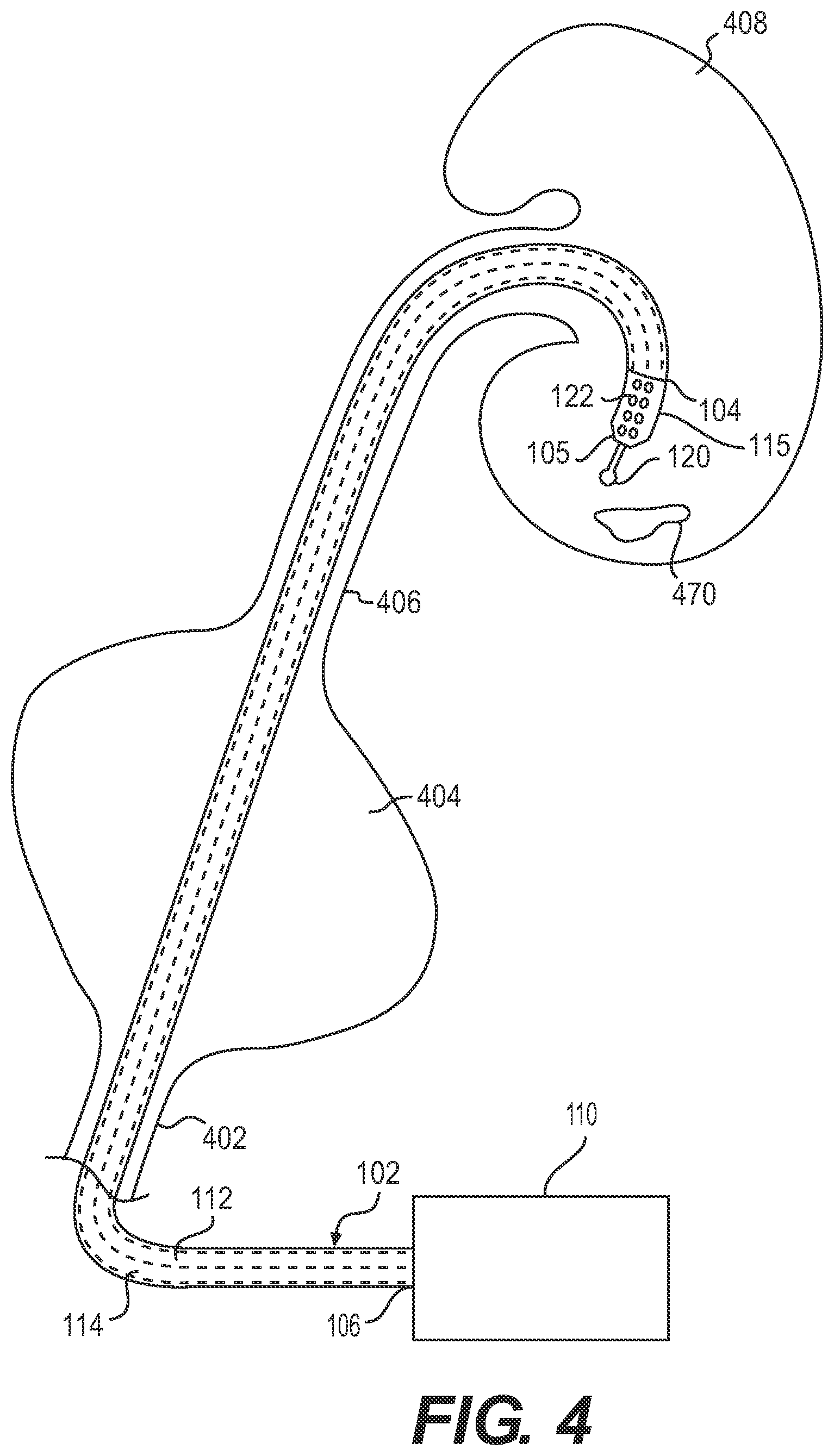 Patent US12396793 Figure 4 – Medical device and methods of use