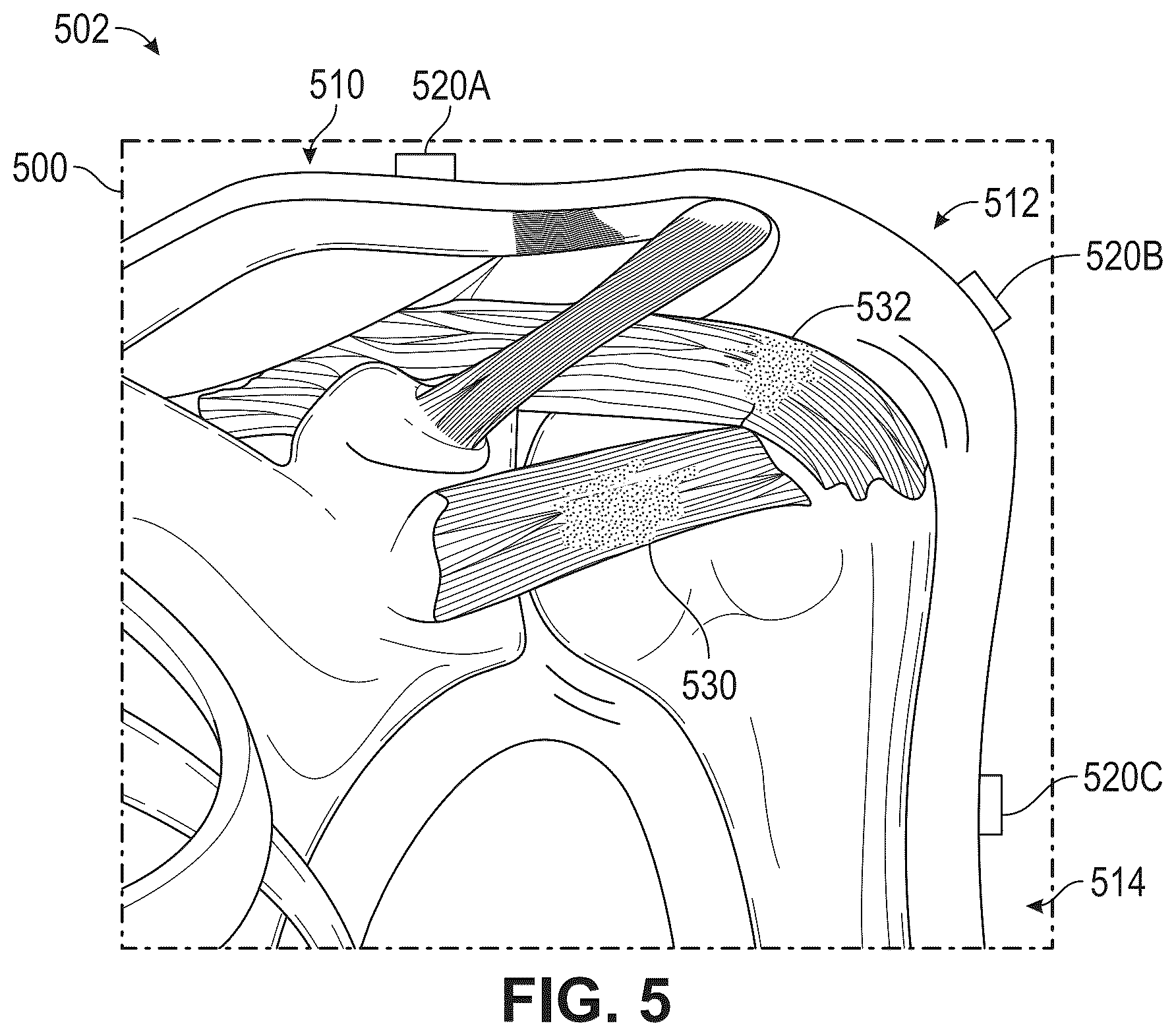 Patent US12396795 Figure 5 – Combining multiple ergonomic risk factors in a single predictive finite element model