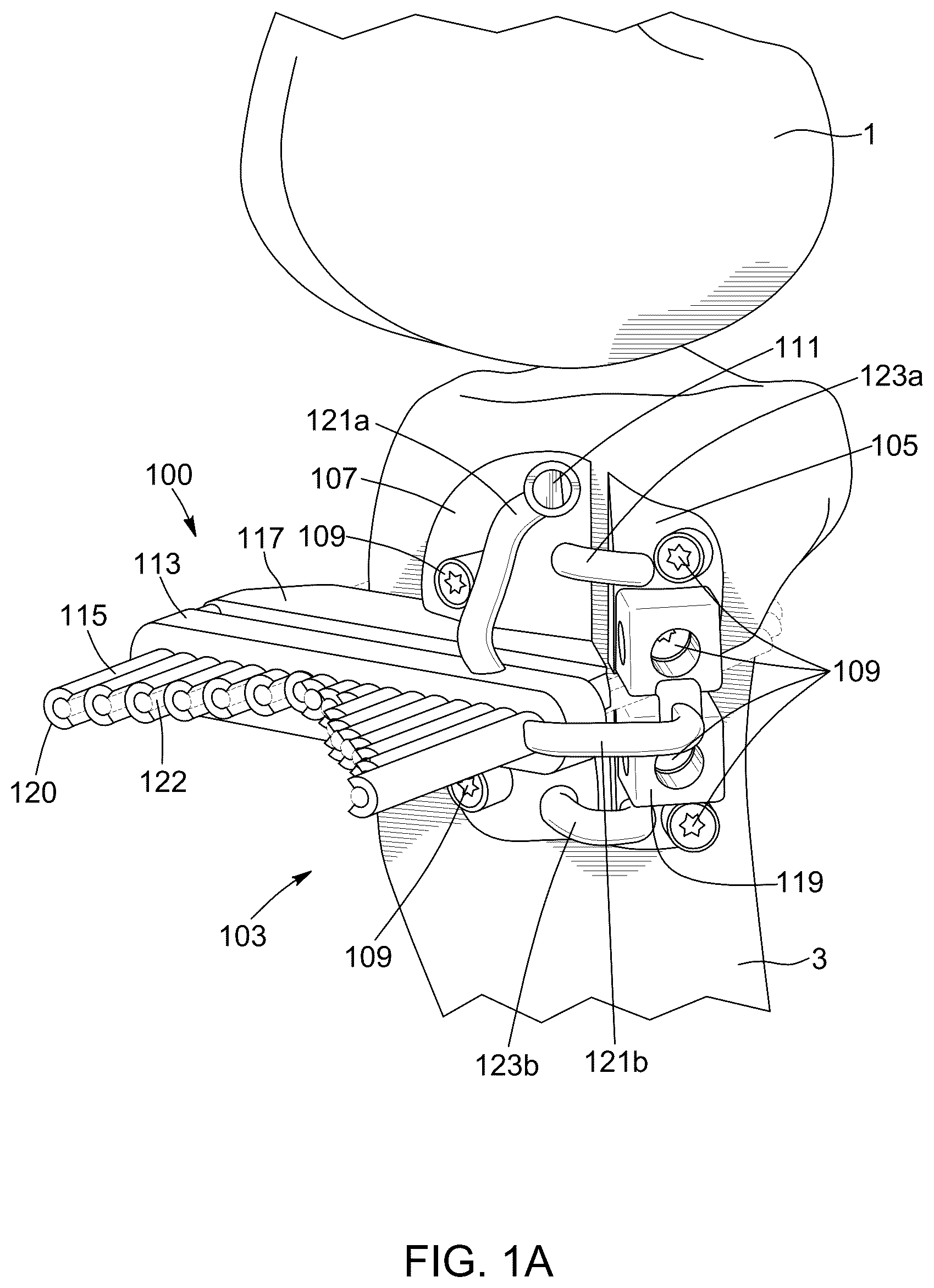 Patent US12396796 Figure 1 – Surgical kit for knee osteotomies and corresponding preoperative planning method