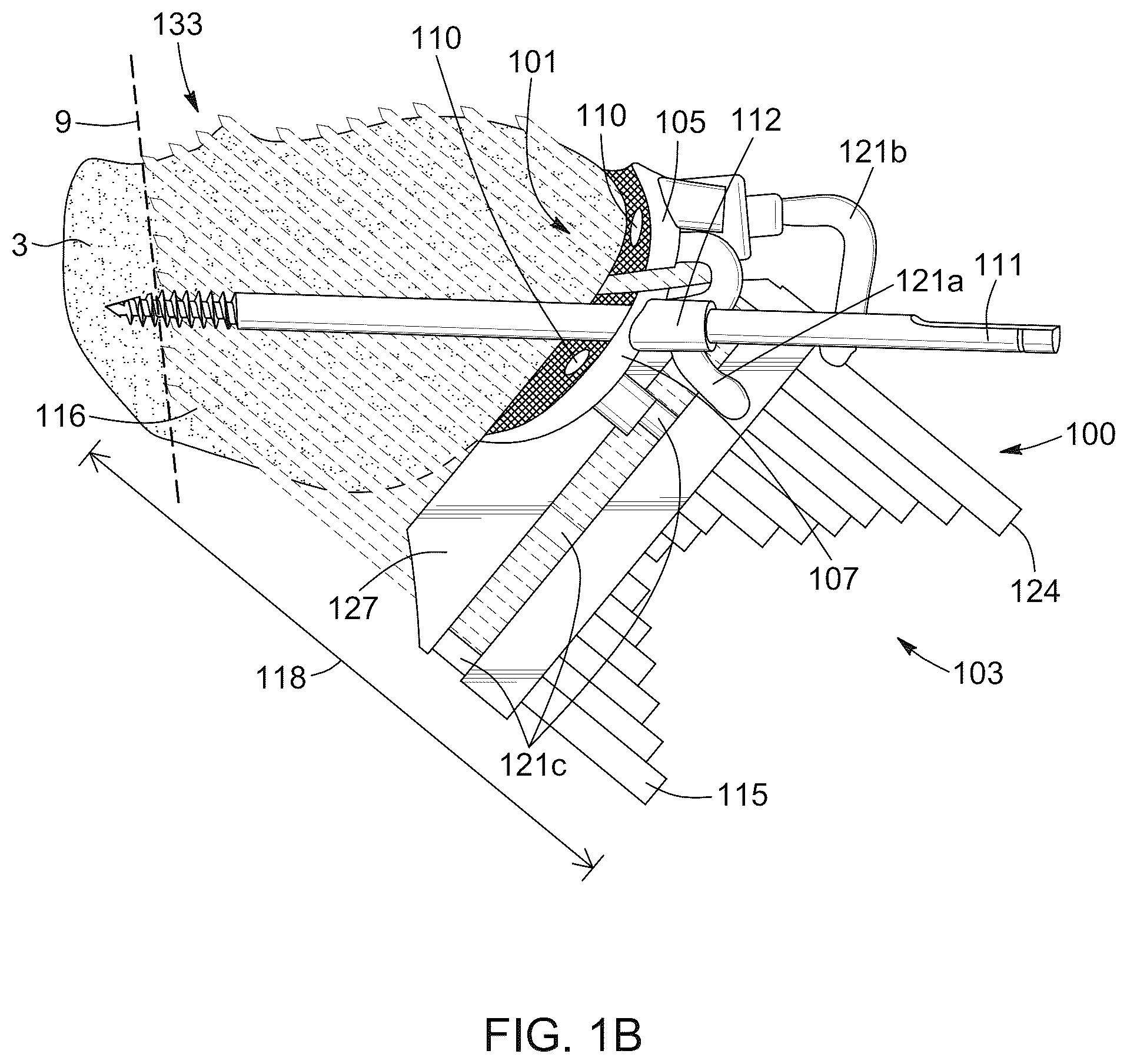 Patent US12396796 Figure 2 – Surgical kit for knee osteotomies and corresponding preoperative planning method