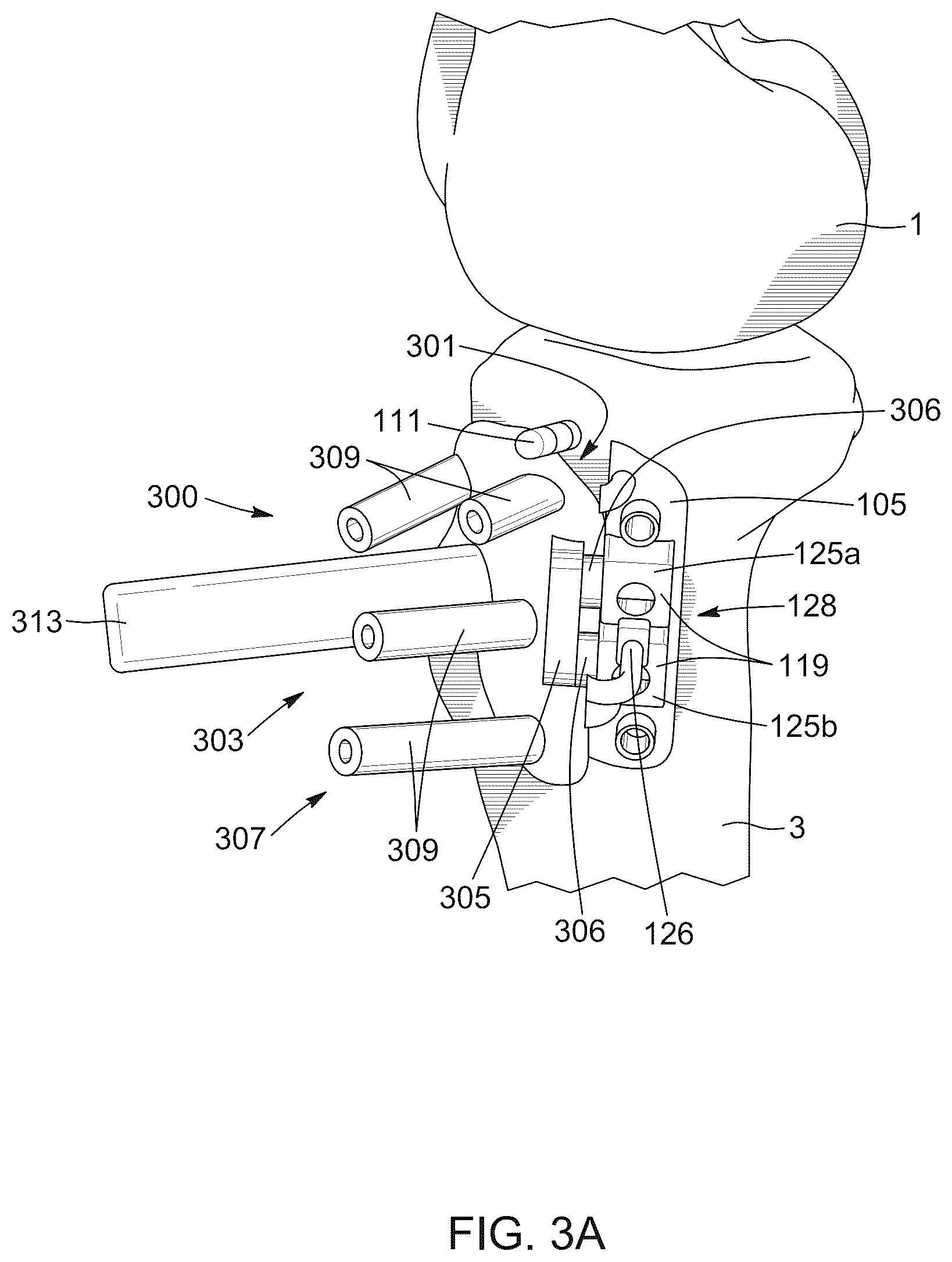 Patent US12396796 Figure 4 – Surgical kit for knee osteotomies and corresponding preoperative planning method