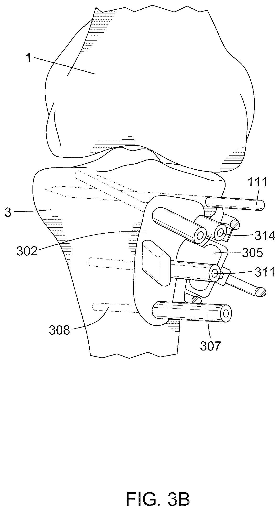 Patent US12396796 Figure 5 – Surgical kit for knee osteotomies and corresponding preoperative planning method