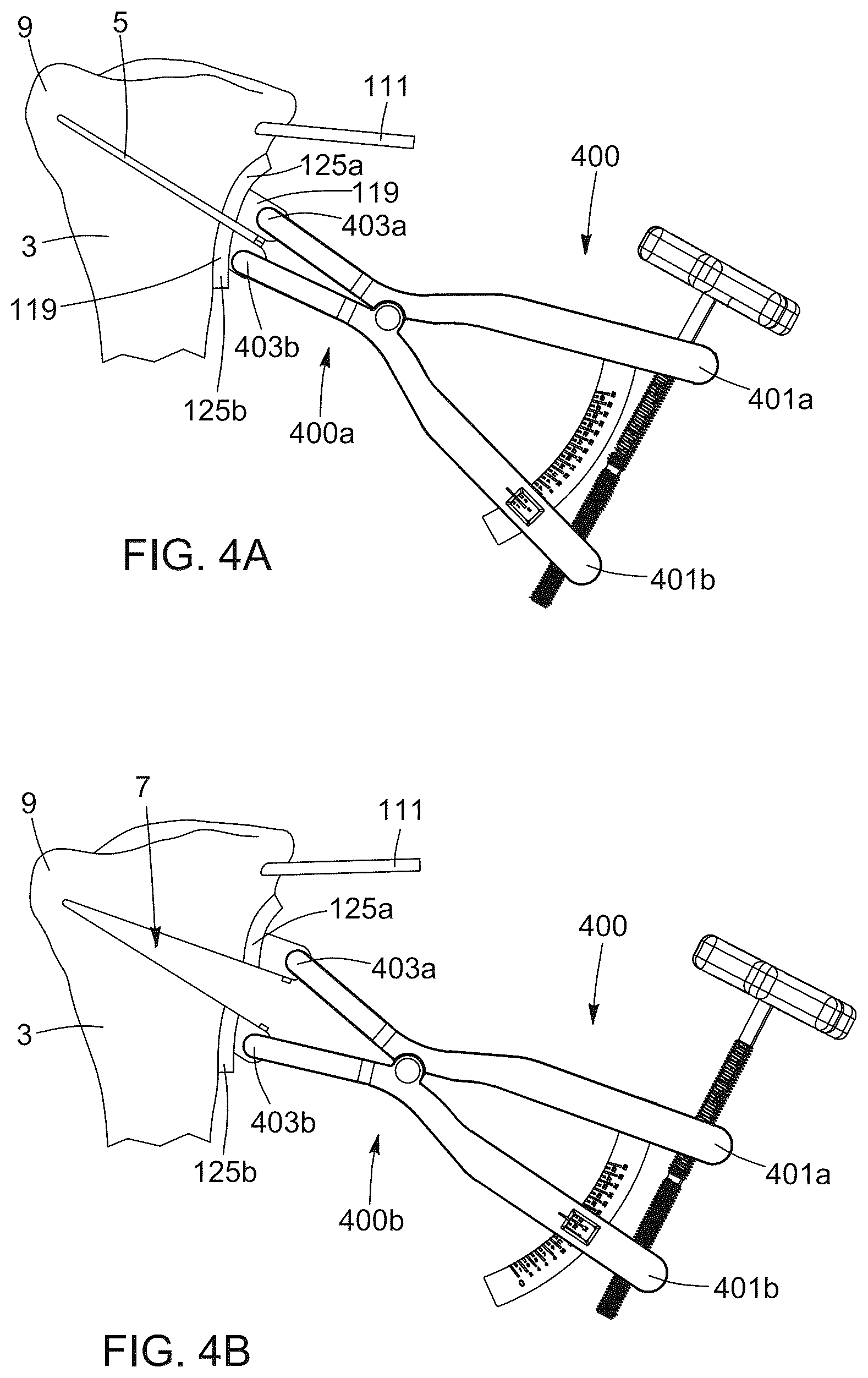 Patent US12396796 Figure 7 – Surgical kit for knee osteotomies and corresponding preoperative planning method