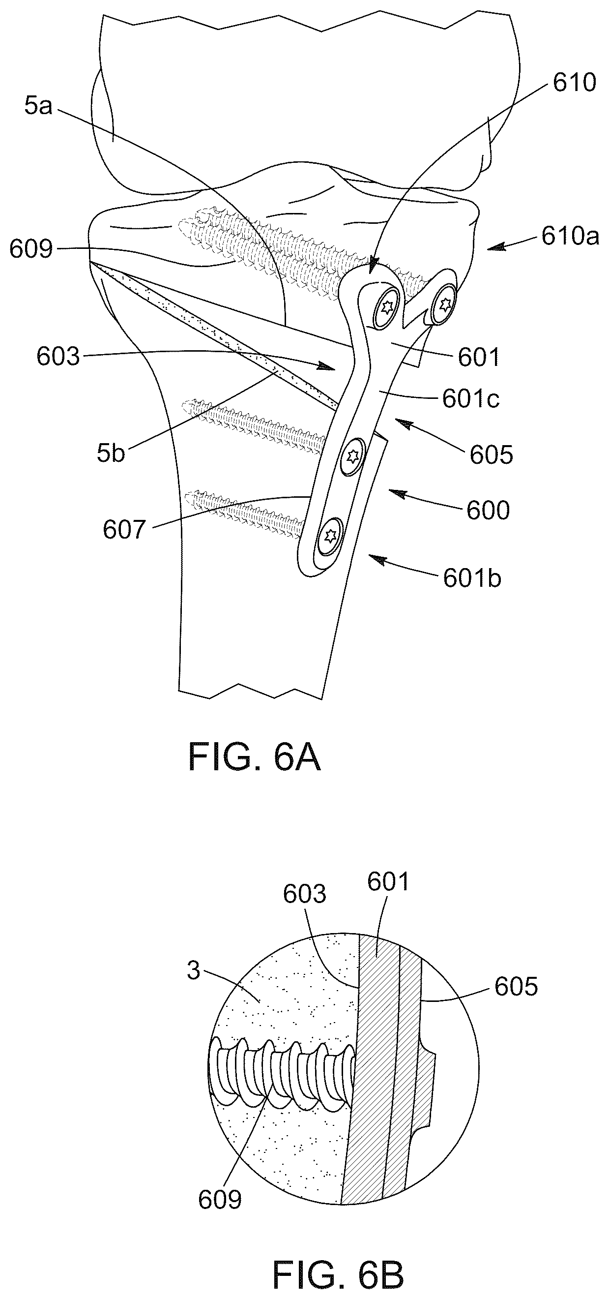 Patent US12396796 Figure 9 – Surgical kit for knee osteotomies and corresponding preoperative planning method