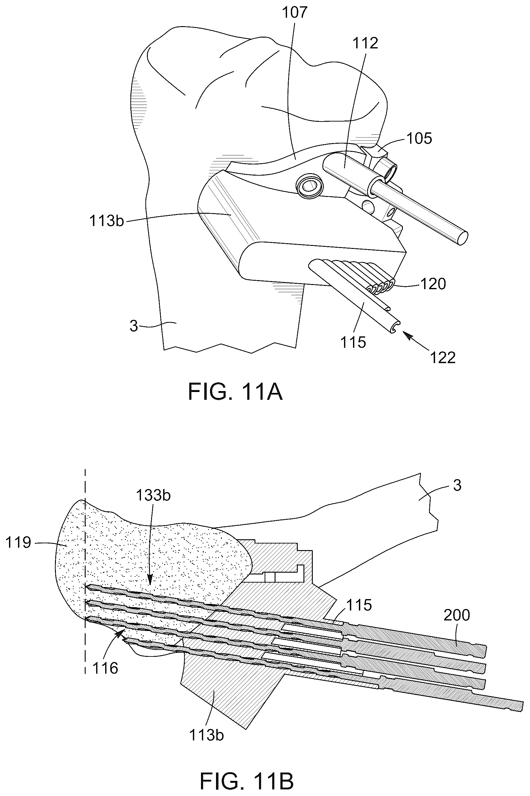 Patent US12396796 Figure 13 – Surgical kit for knee osteotomies and corresponding preoperative planning method