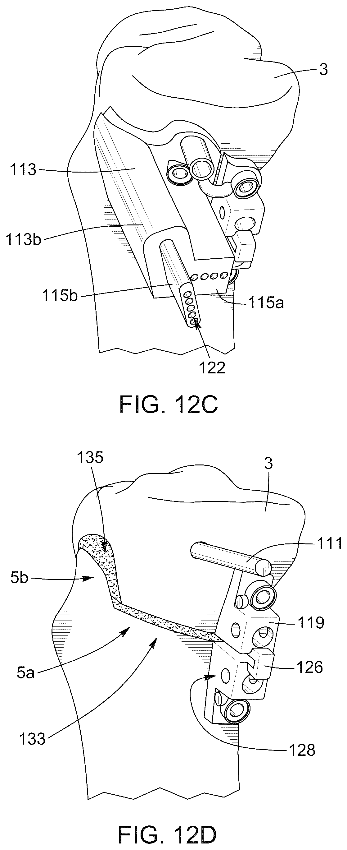 Patent US12396796 Figure 16 – Surgical kit for knee osteotomies and corresponding preoperative planning method