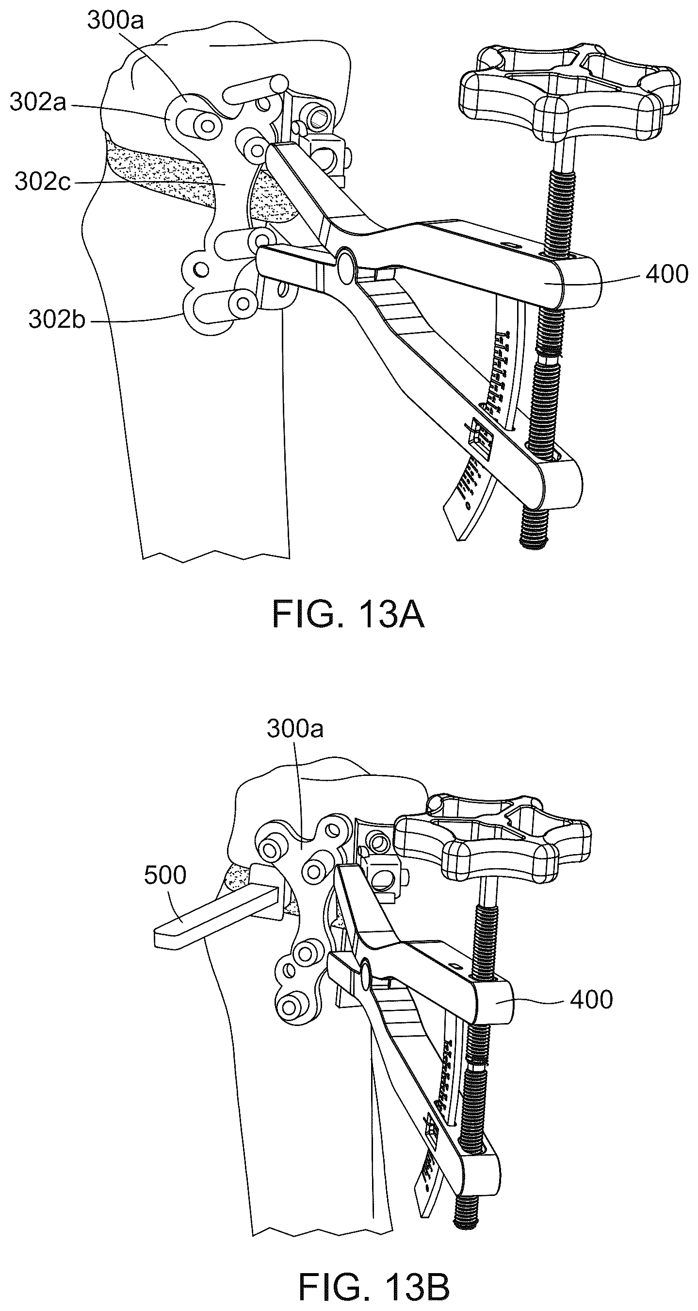 Patent US12396796 Figure 18 – Surgical kit for knee osteotomies and corresponding preoperative planning method