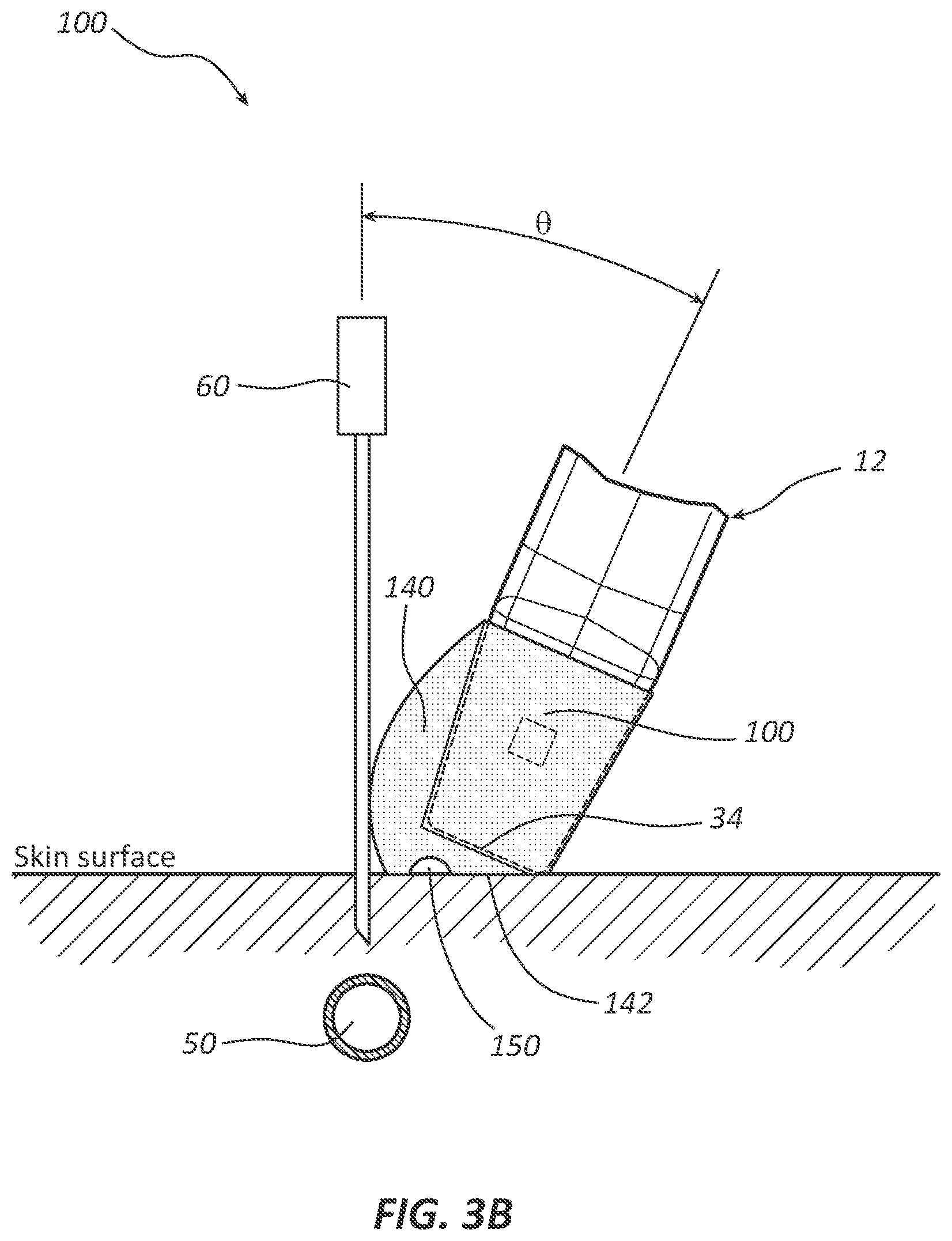 Patent US12396798 Figure 5 – Probe shield