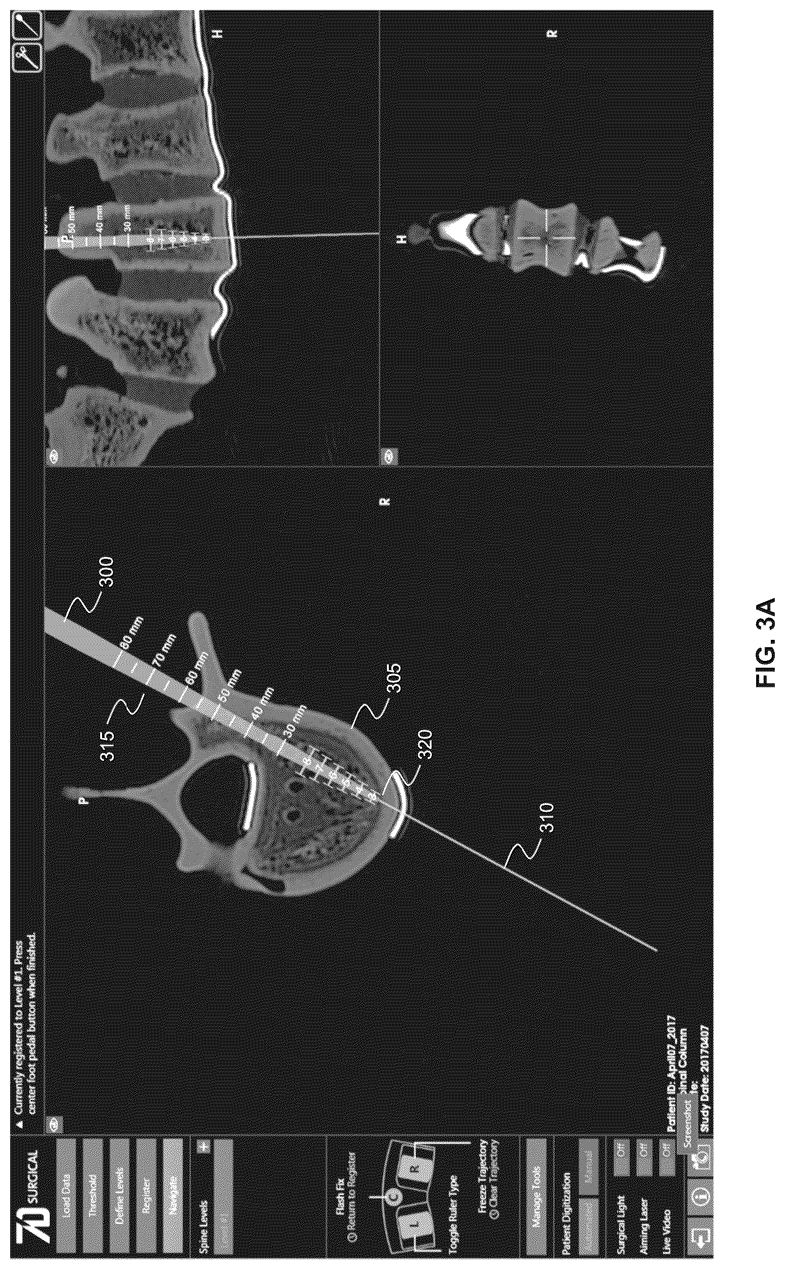 Patent US12396803 Figure 3 – Systems and methods for performing intraoperative guidance