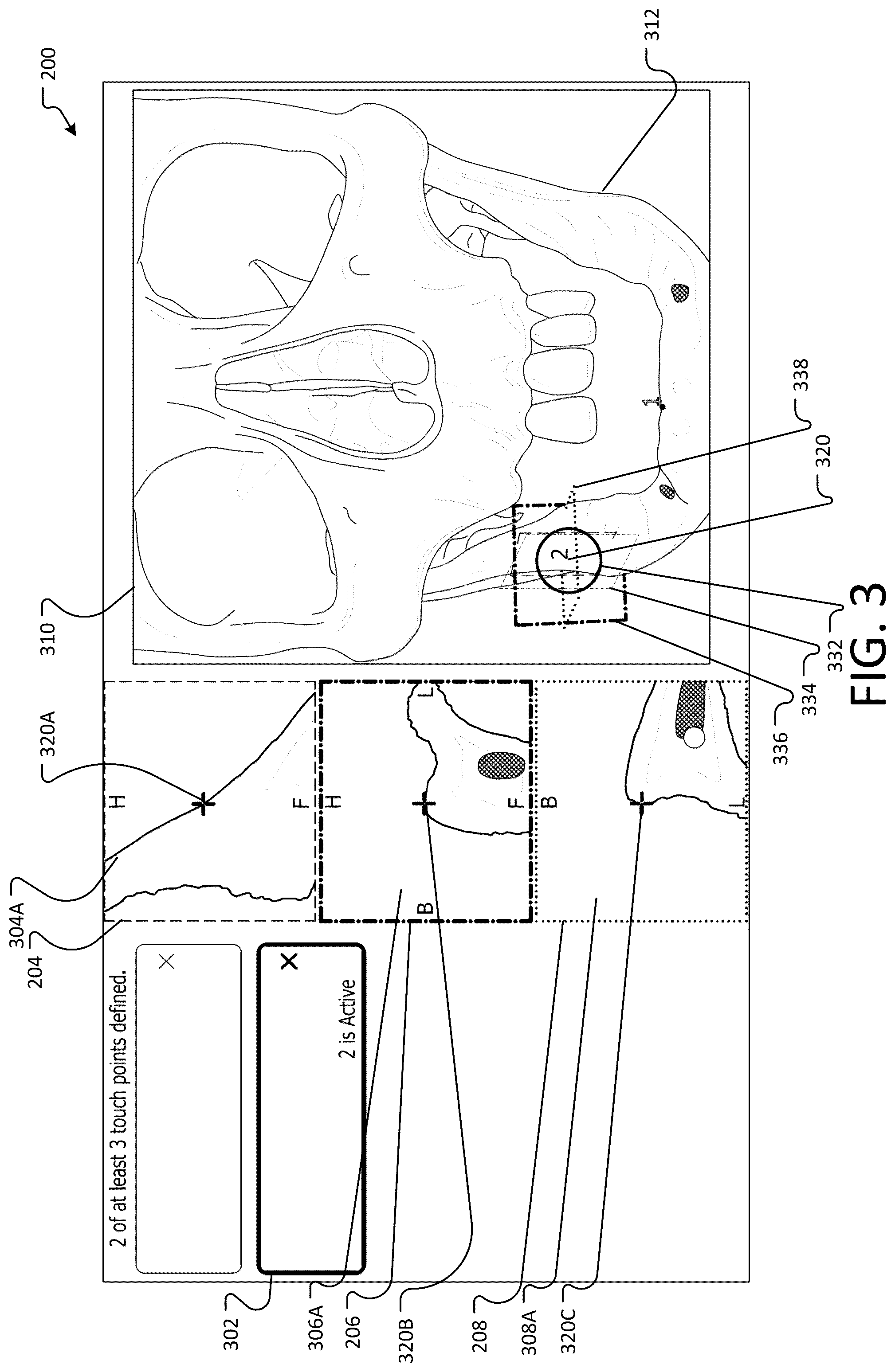 Patent US12396804 Figure 3 – Landmark registration system for image-guided navigation