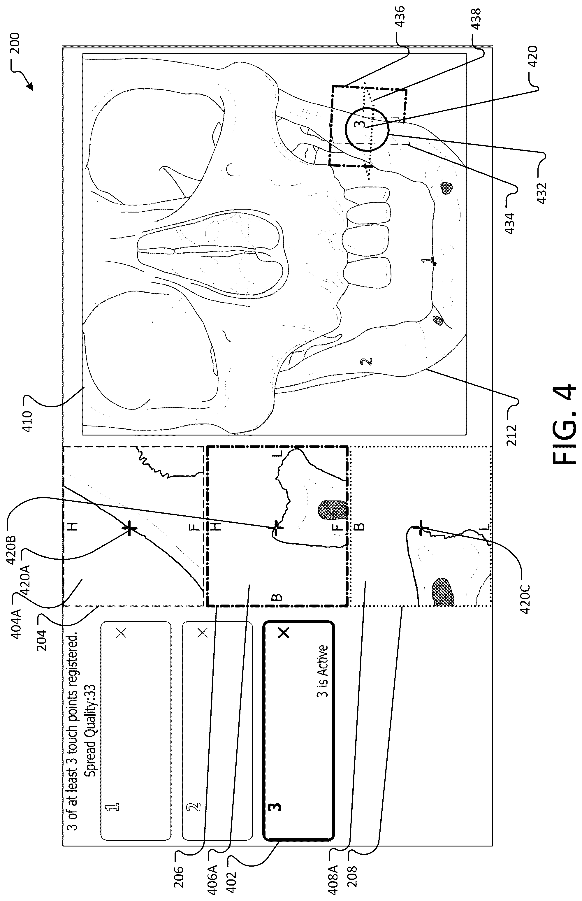 Patent US12396804 Figure 4 – Landmark registration system for image-guided navigation