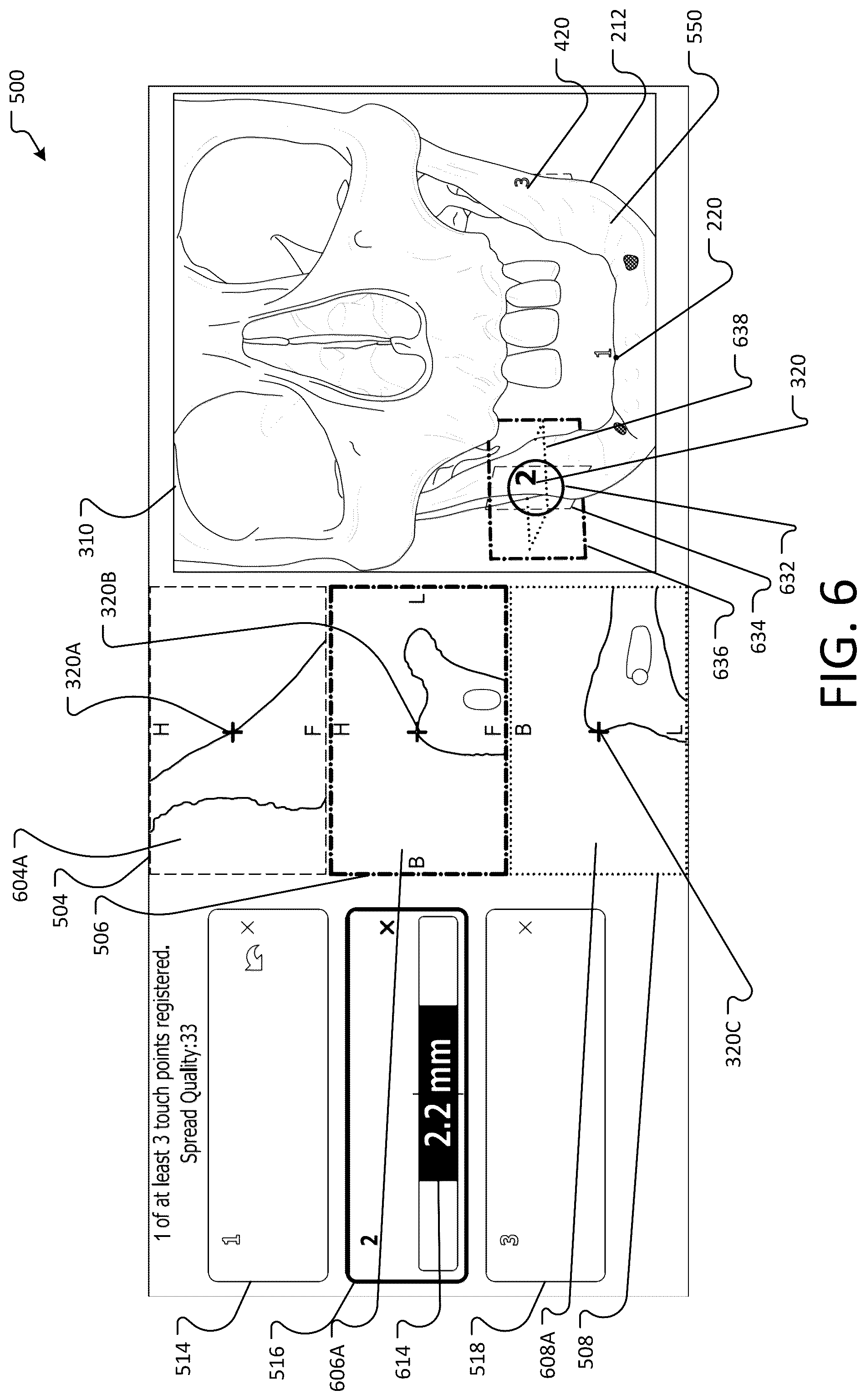 Patent US12396804 Figure 6 – Landmark registration system for image-guided navigation