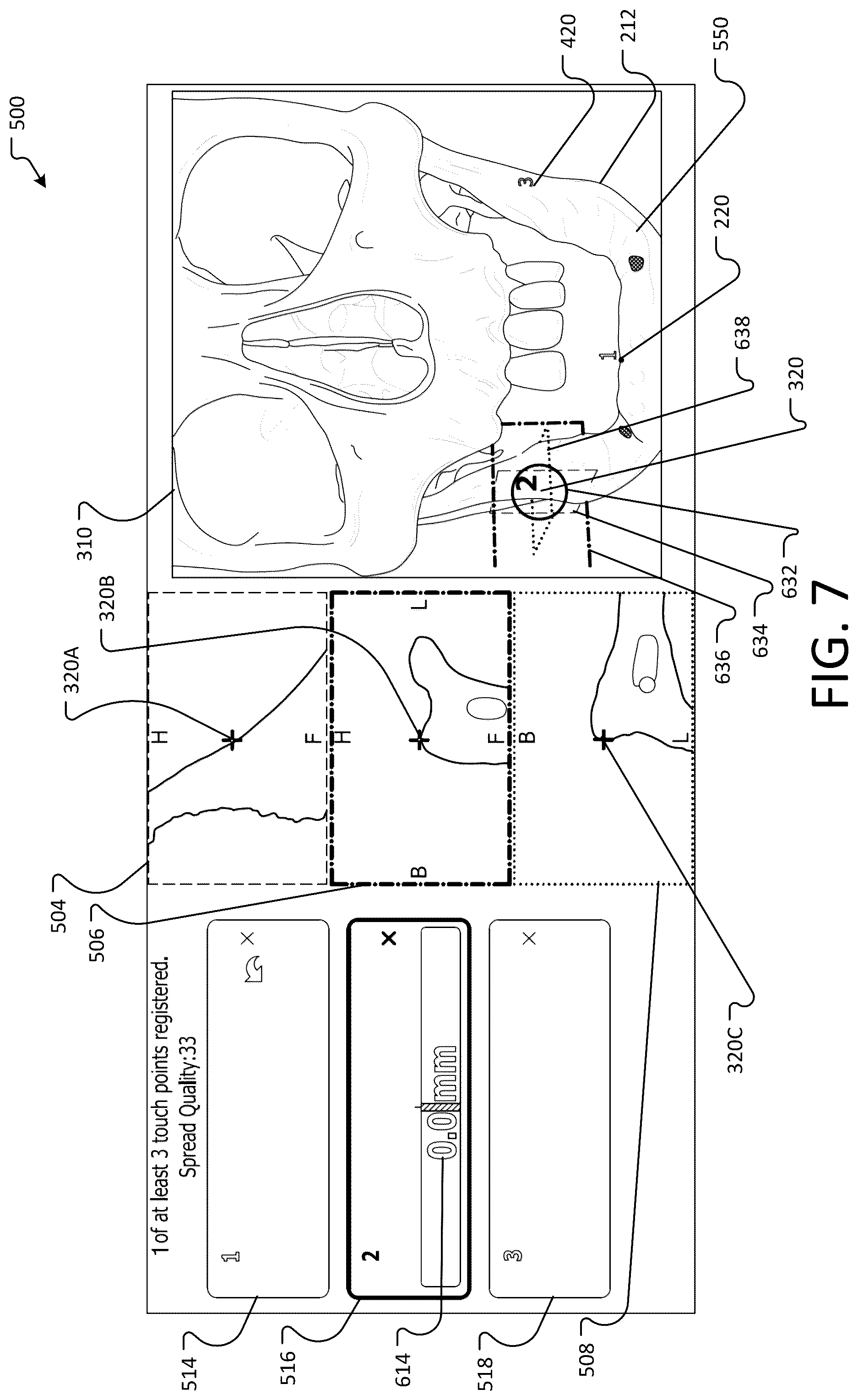 Patent US12396804 Figure 7 – Landmark registration system for image-guided navigation