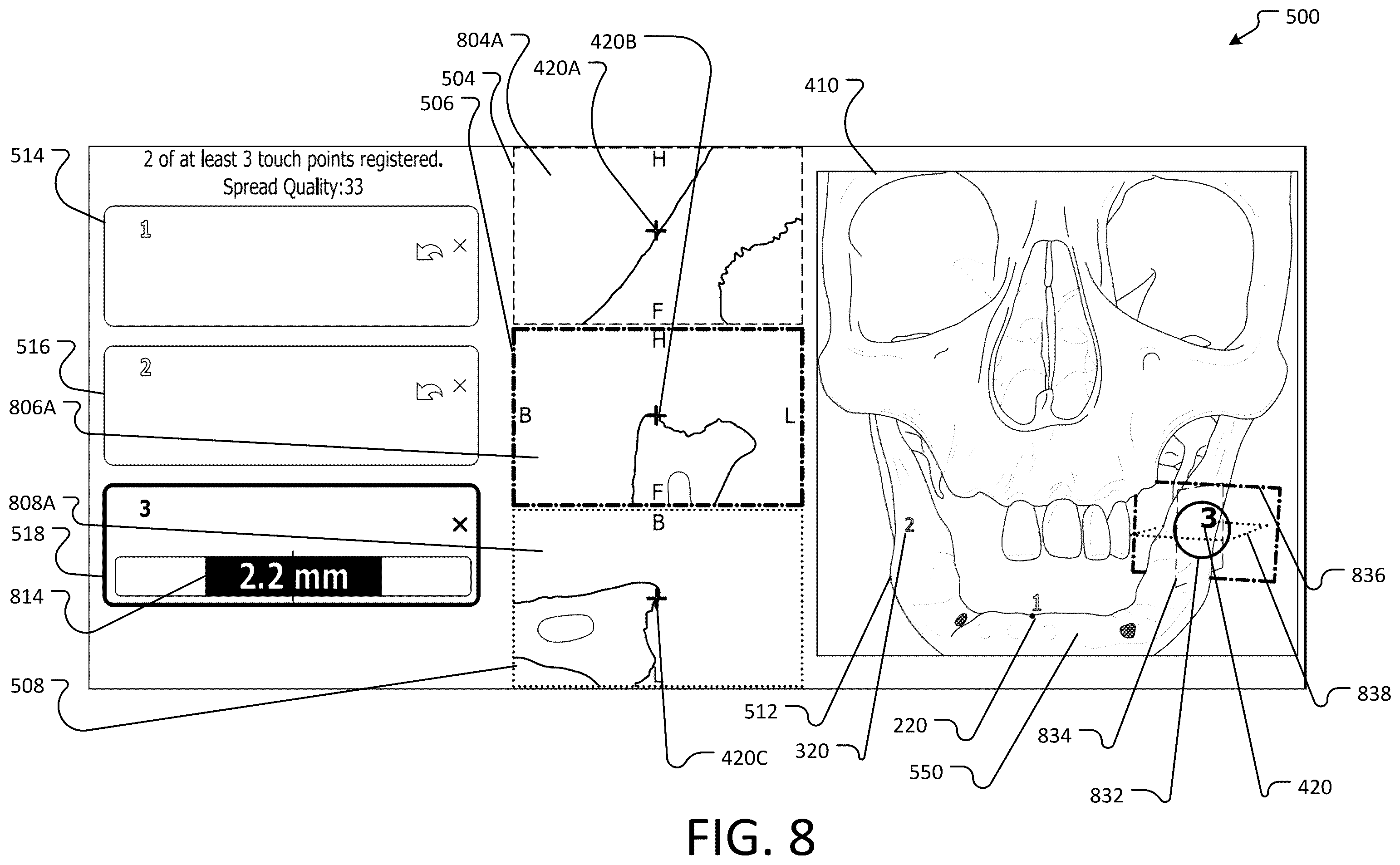 Patent US12396804 Figure 8 – Landmark registration system for image-guided navigation
