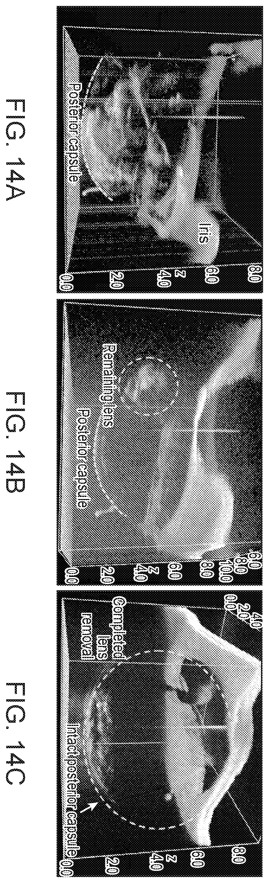 Patent US12396810 Figure 15 – System and method for automated image-guided robotic intraocular surgery