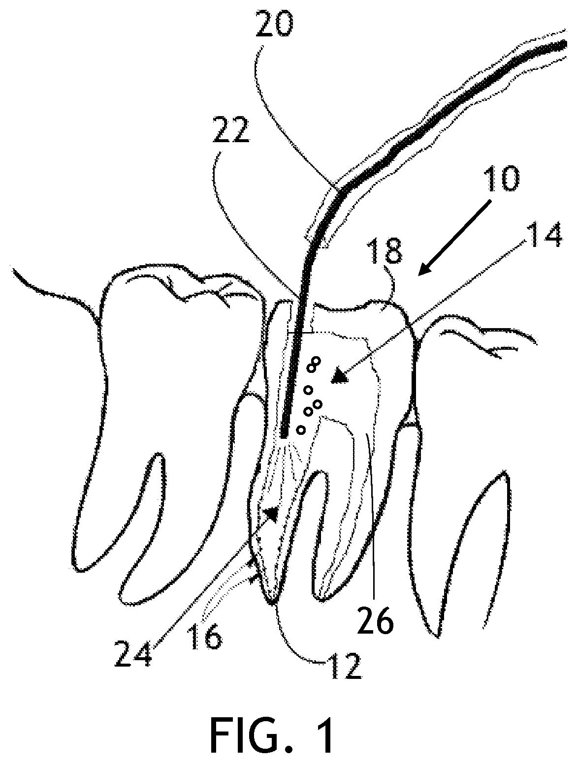 Patent US12396823 Figure 1 – Laser endodontic procedures utilizing alcohol based indocyanine green solutions