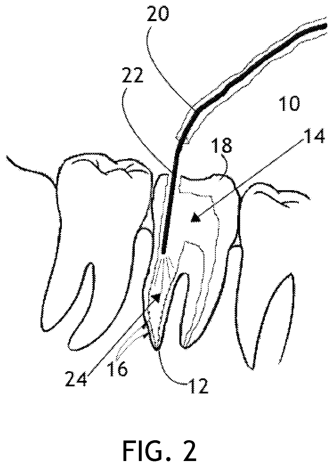 Patent US12396823 Figure 2 – Laser endodontic procedures utilizing alcohol based indocyanine green solutions