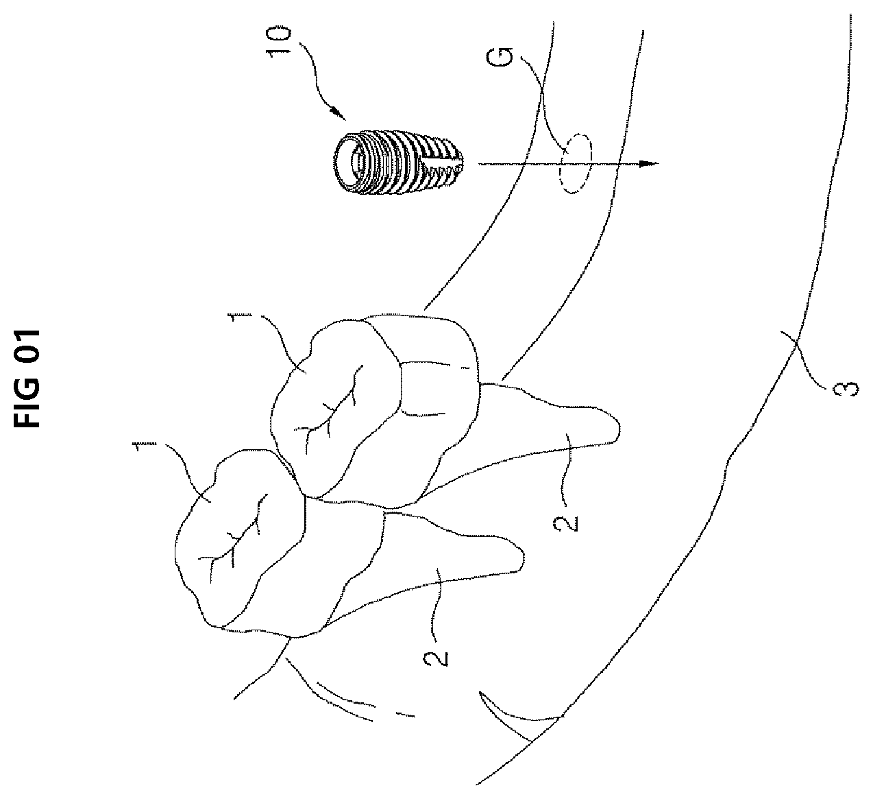 Patent US12396825 Figure 1 – Fixture of dental implant