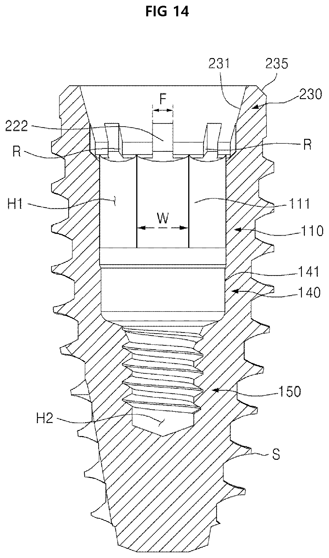 Patent US12396825 Figure 14 – Fixture of dental implant