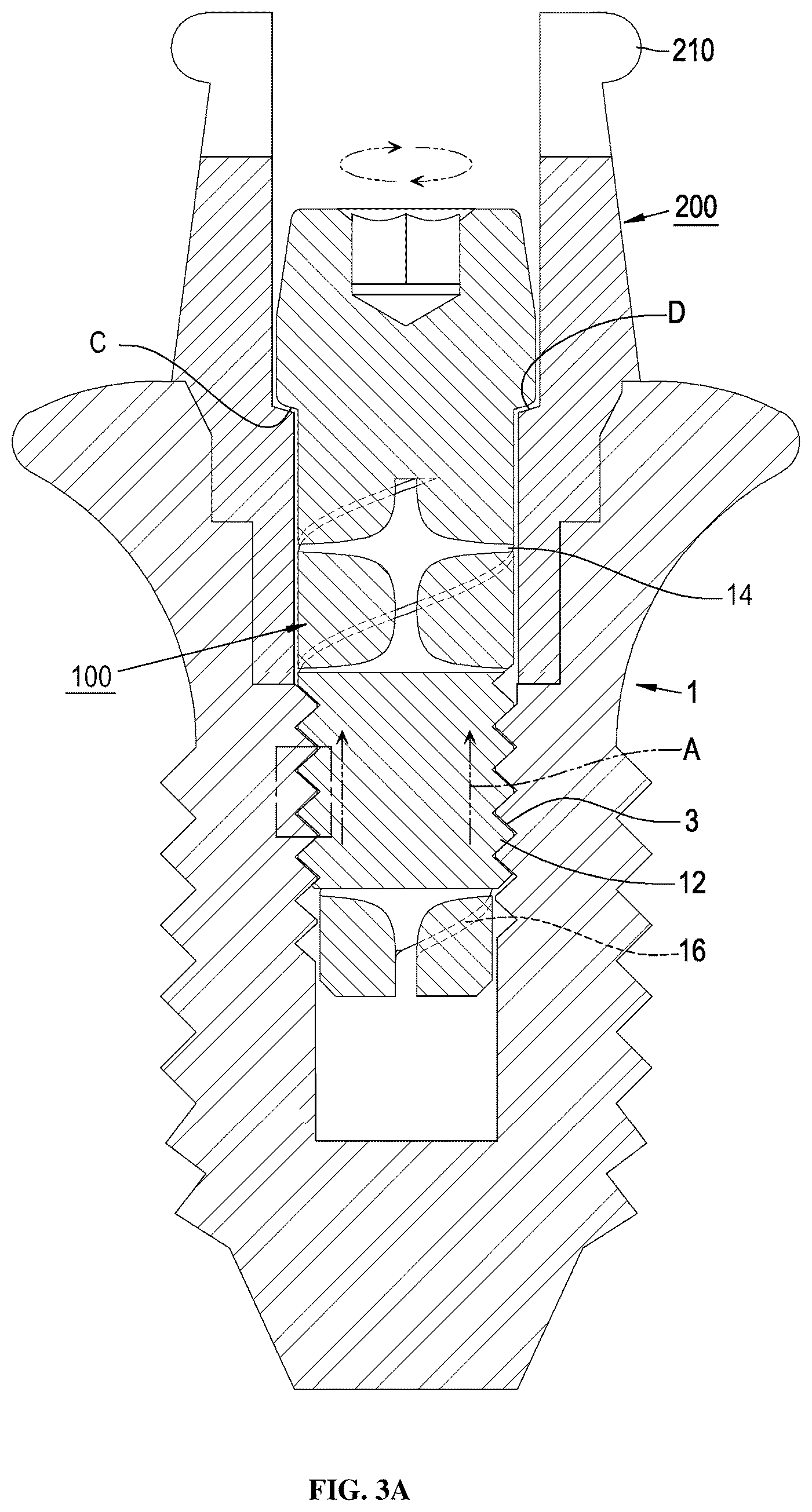 Patent US12396826 Figure 5 – Dental implant abutment having occlusal force buffering function