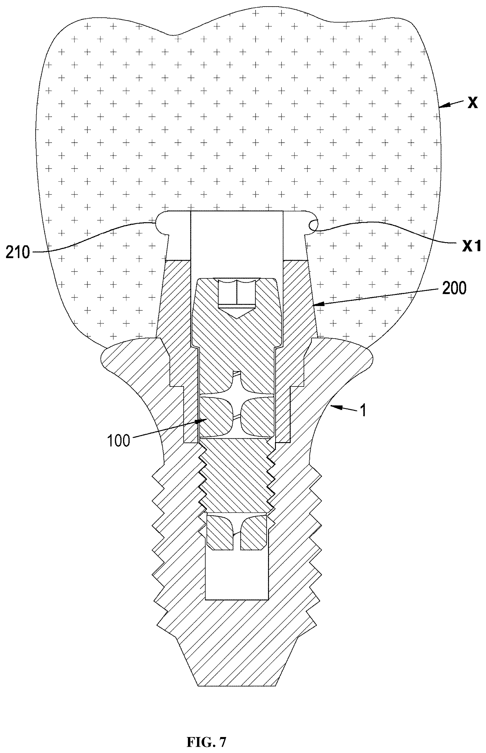 Patent US12396826 Figure 11 – Dental implant abutment having occlusal force buffering function