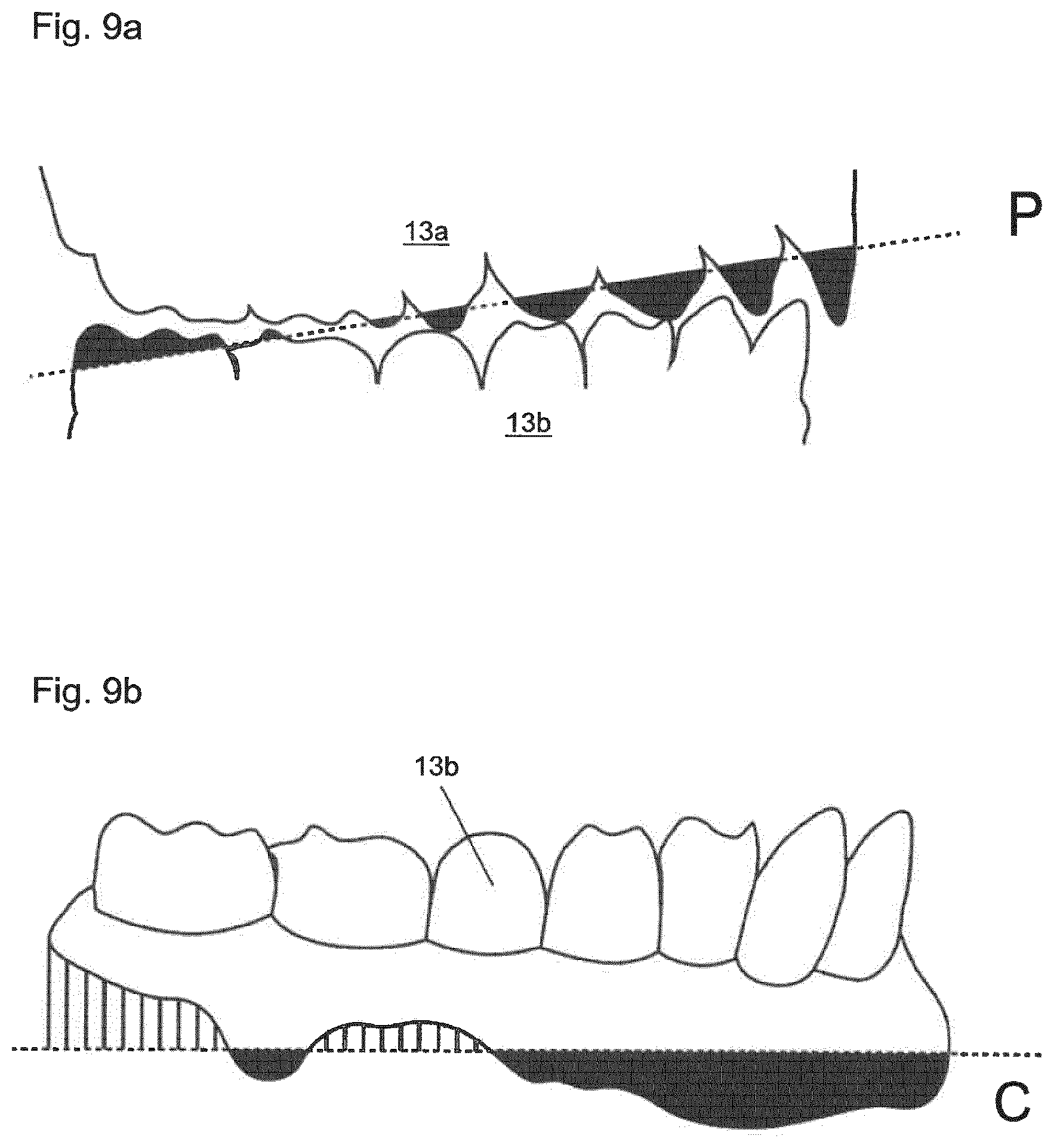 Patent US12396828 Figure 9 – Method for providing a 3D-print data set of a dental model structure, computer program product, dental model structure, mounting plate and dental model system