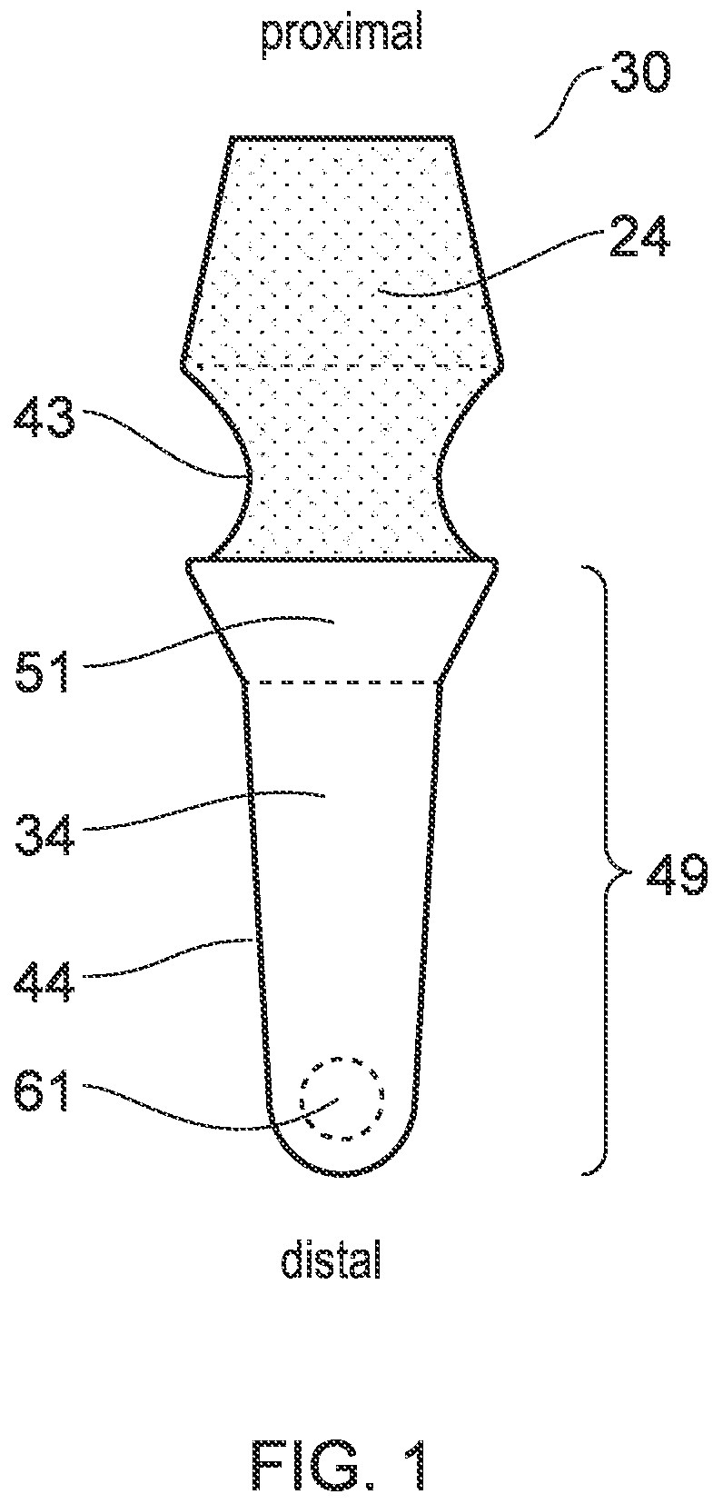 Patent US12396832 Figure 1 – Implant