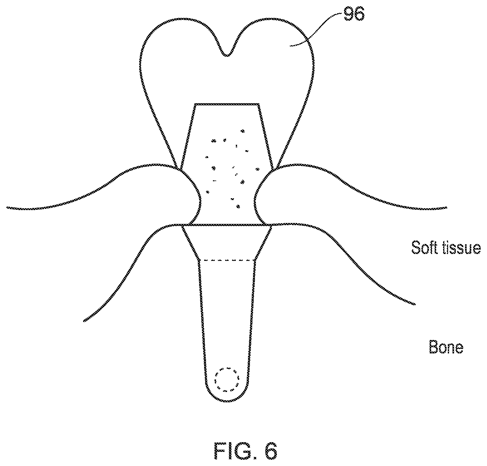 Patent US12396832 Figure 6 – Implant