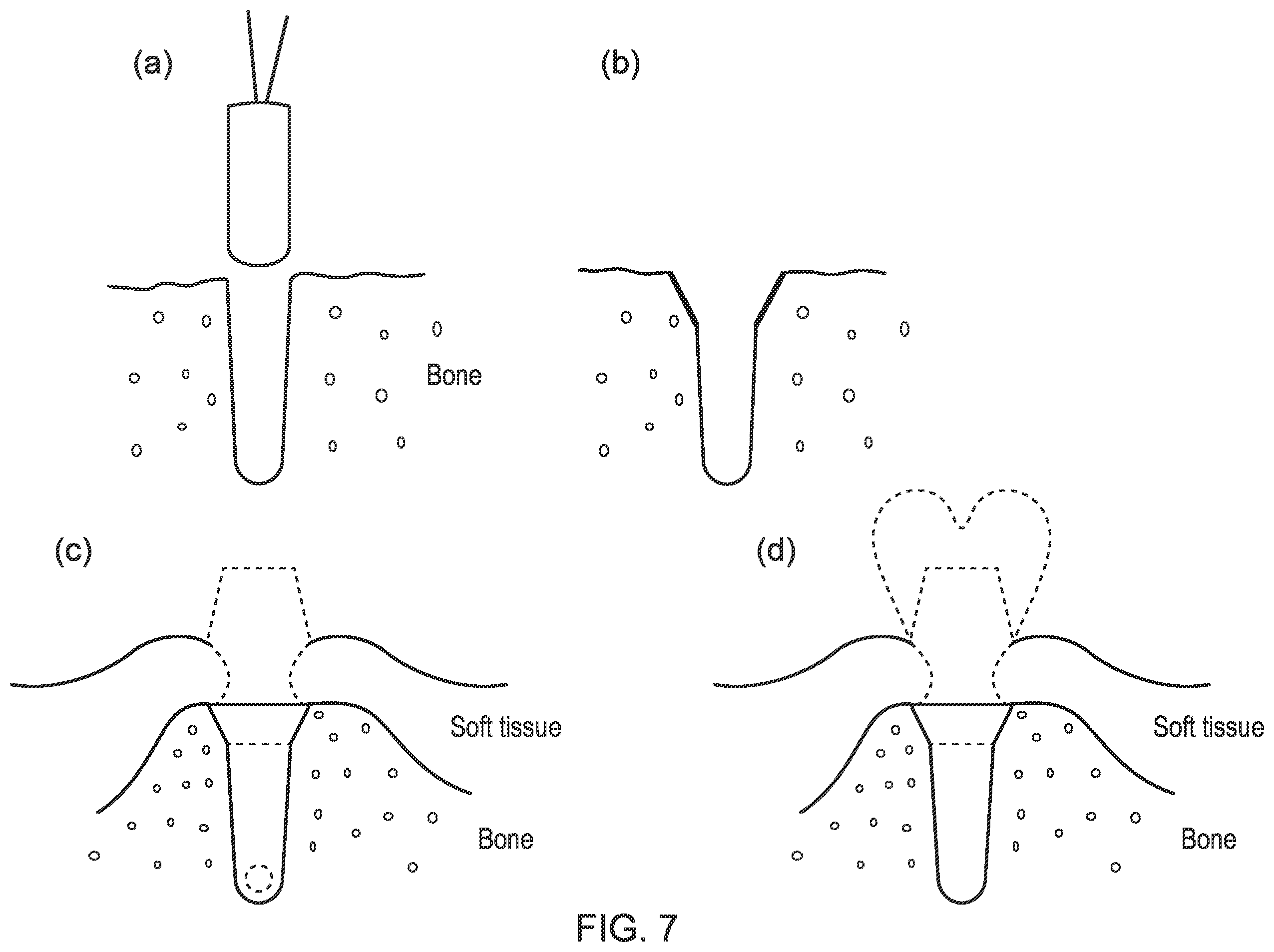 Patent US12396832 Figure 7 – Implant