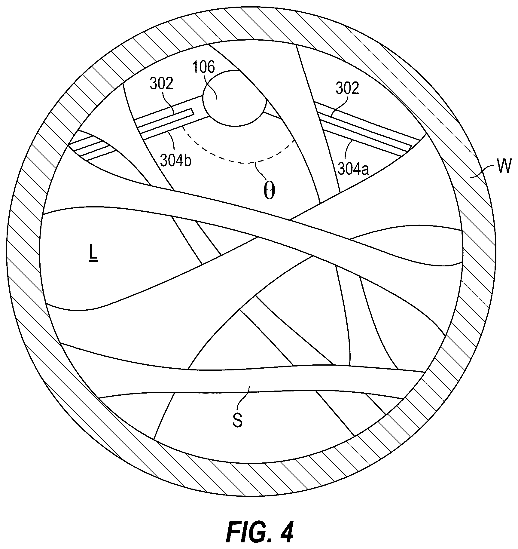 Patent US12396835 Figure 4 – Interventional systems and associated devices and methods
