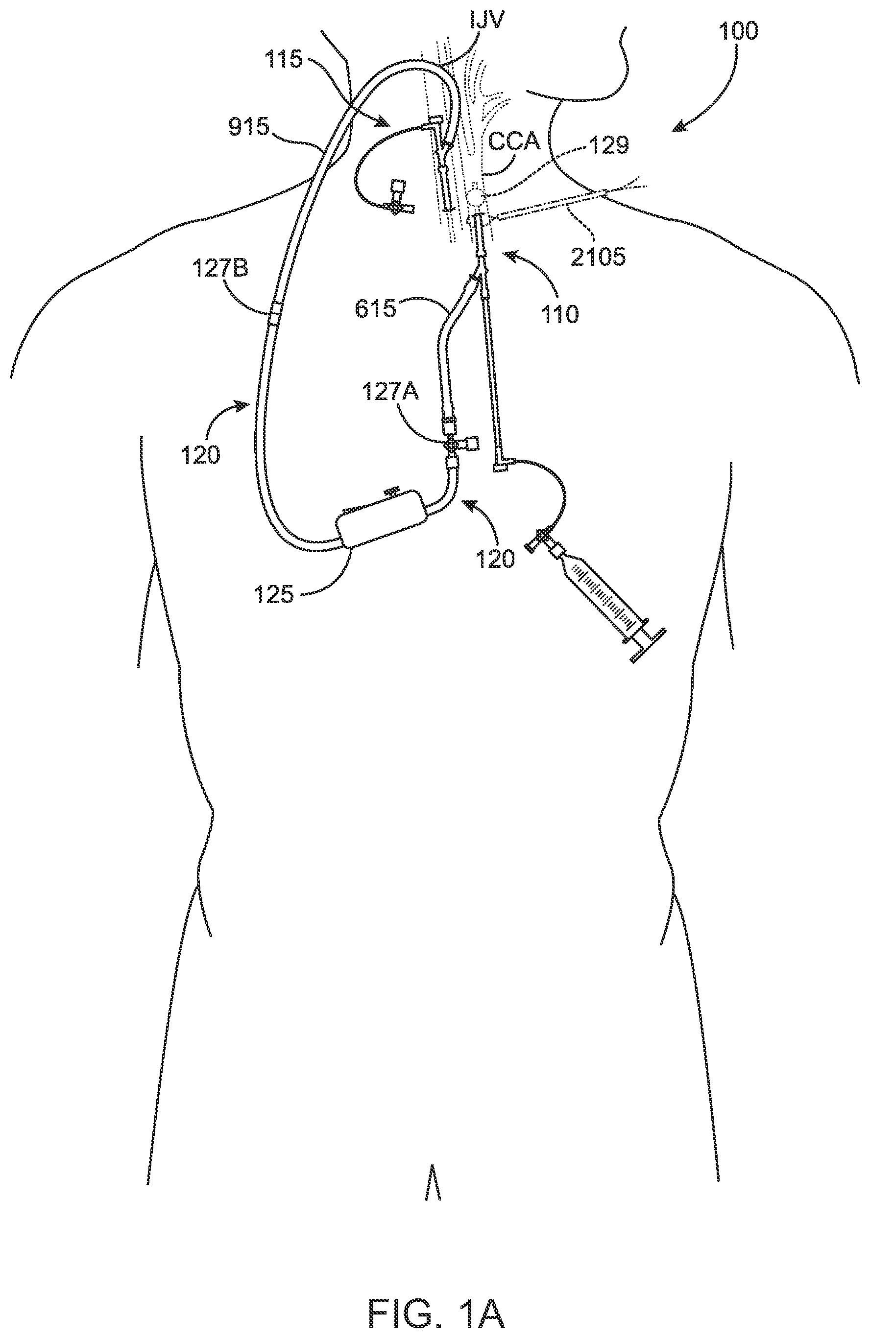 Patent US12396836 Figure 1 – Fenestrated sheath for embolic protection during transcarotid carotid artery revascularization