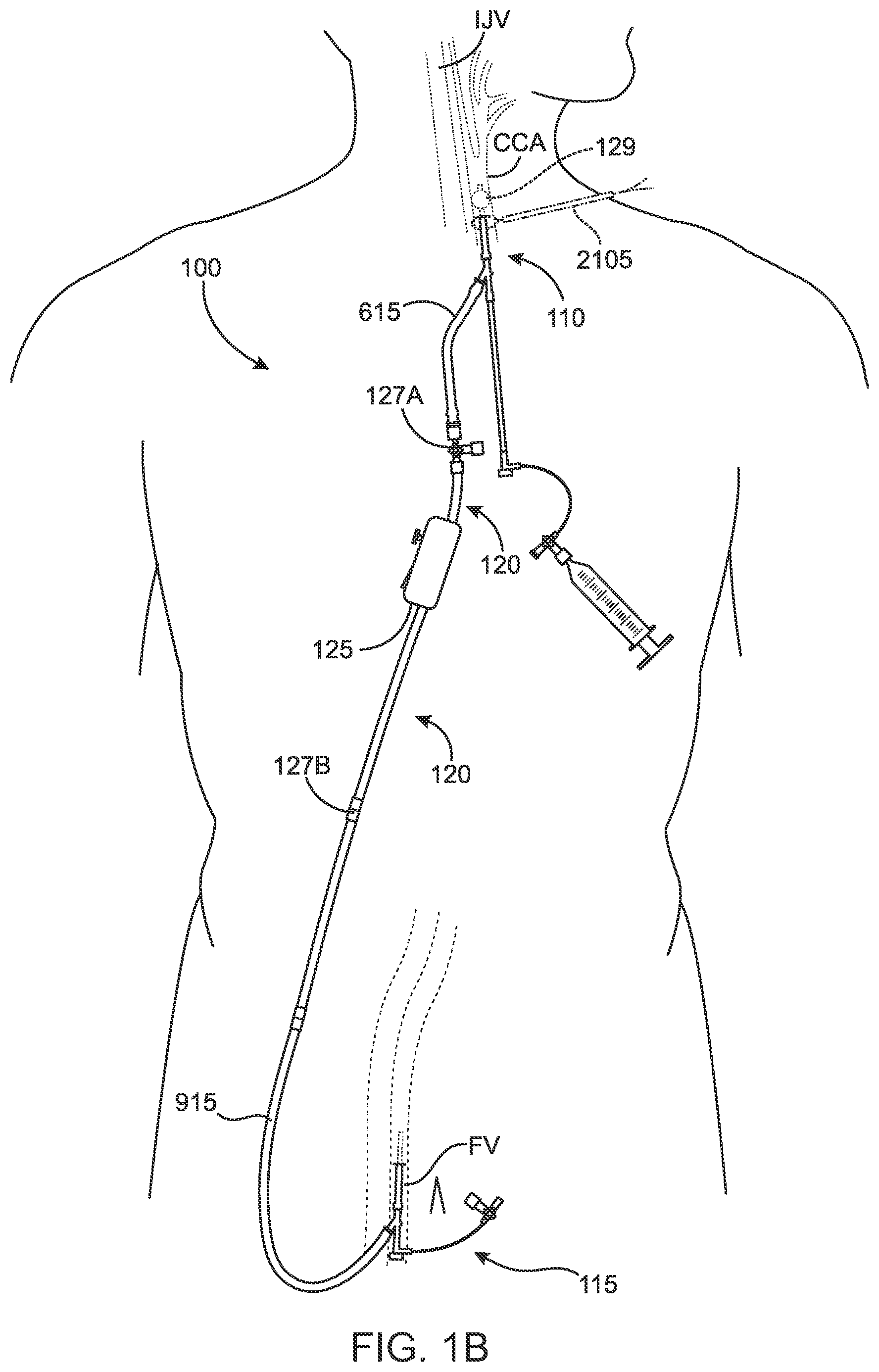 Patent US12396836 Figure 2 – Fenestrated sheath for embolic protection during transcarotid carotid artery revascularization