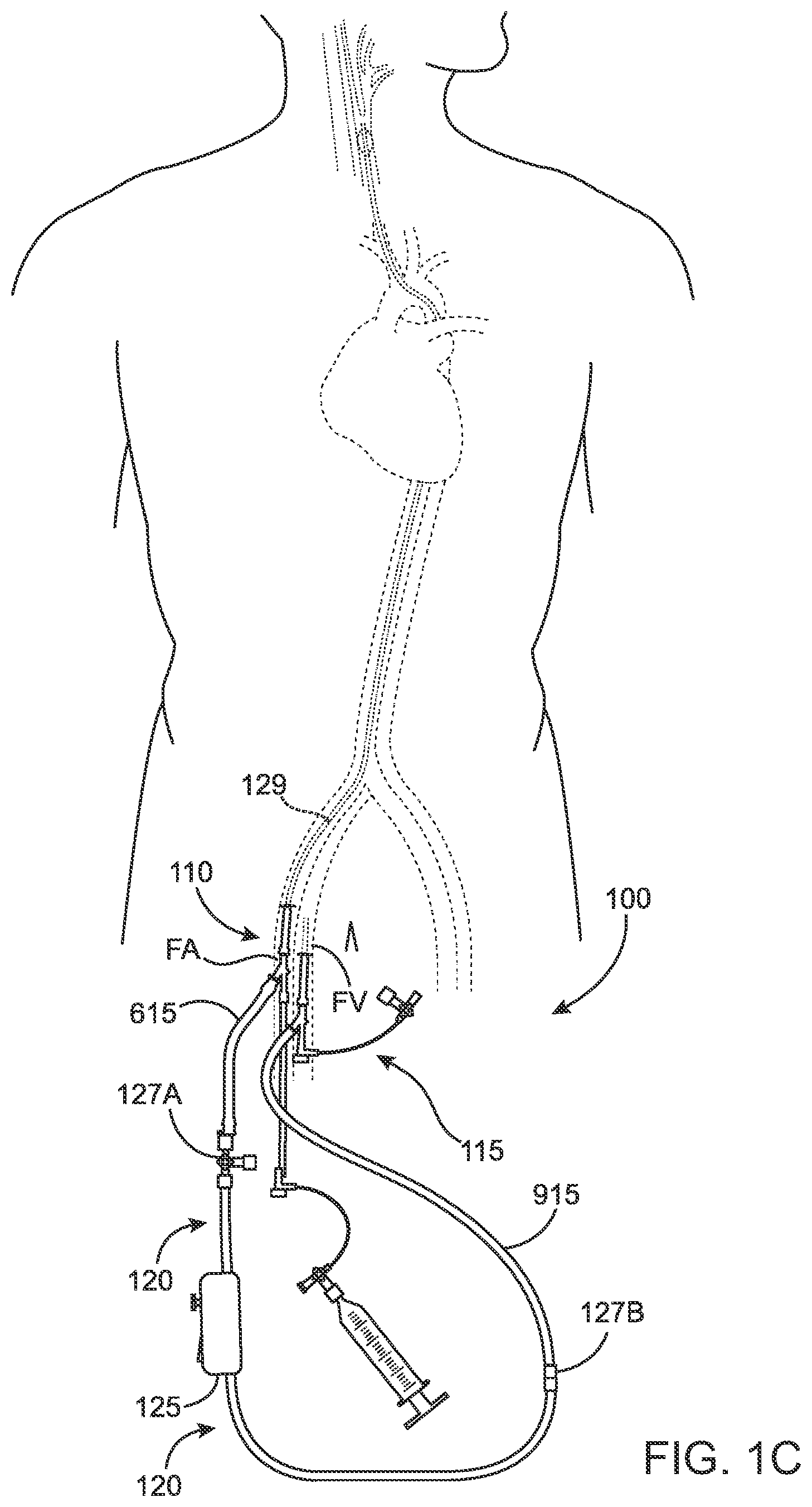 Patent US12396836 Figure 3 – Fenestrated sheath for embolic protection during transcarotid carotid artery revascularization