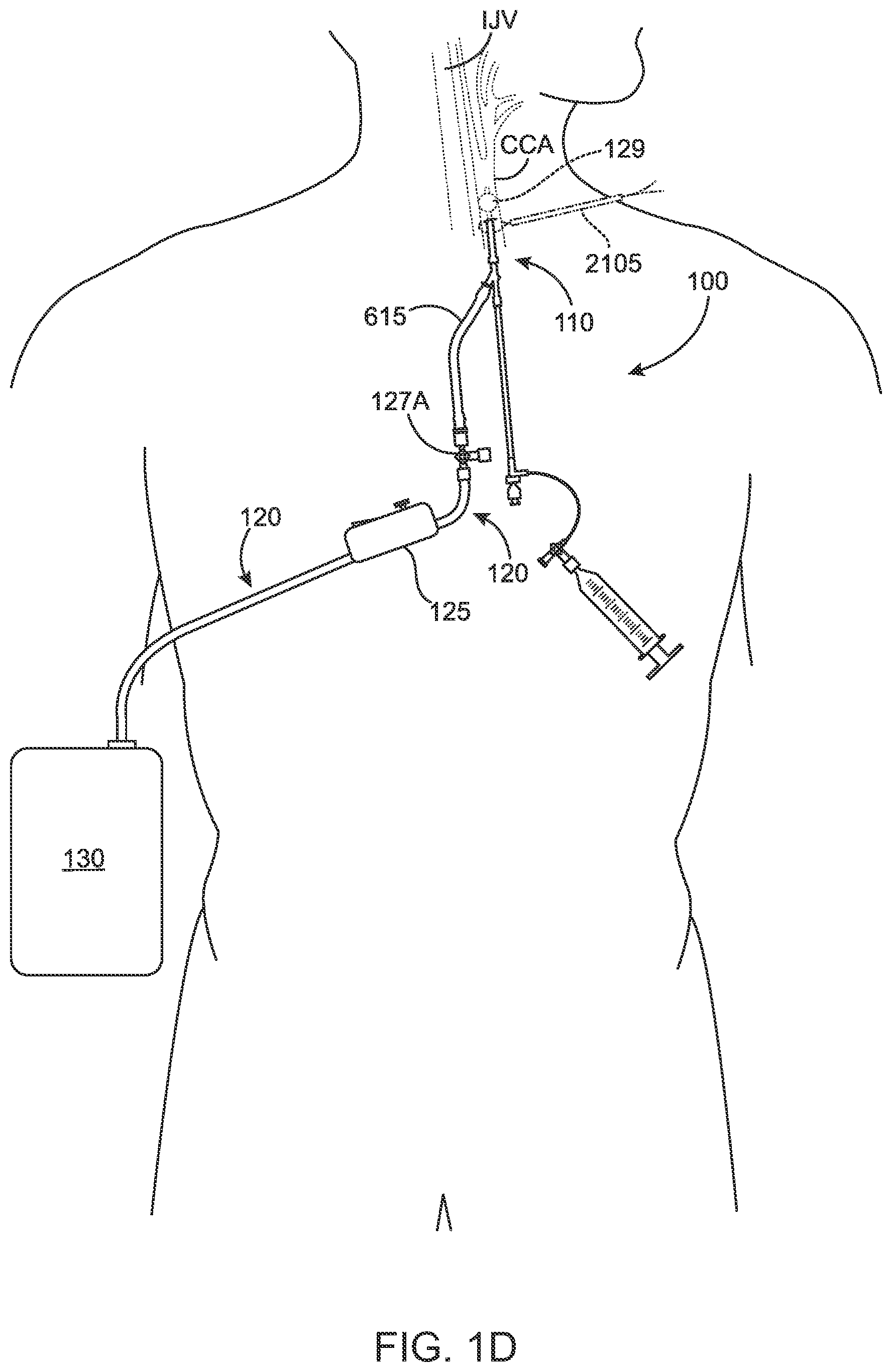 Patent US12396836 Figure 4 – Fenestrated sheath for embolic protection during transcarotid carotid artery revascularization