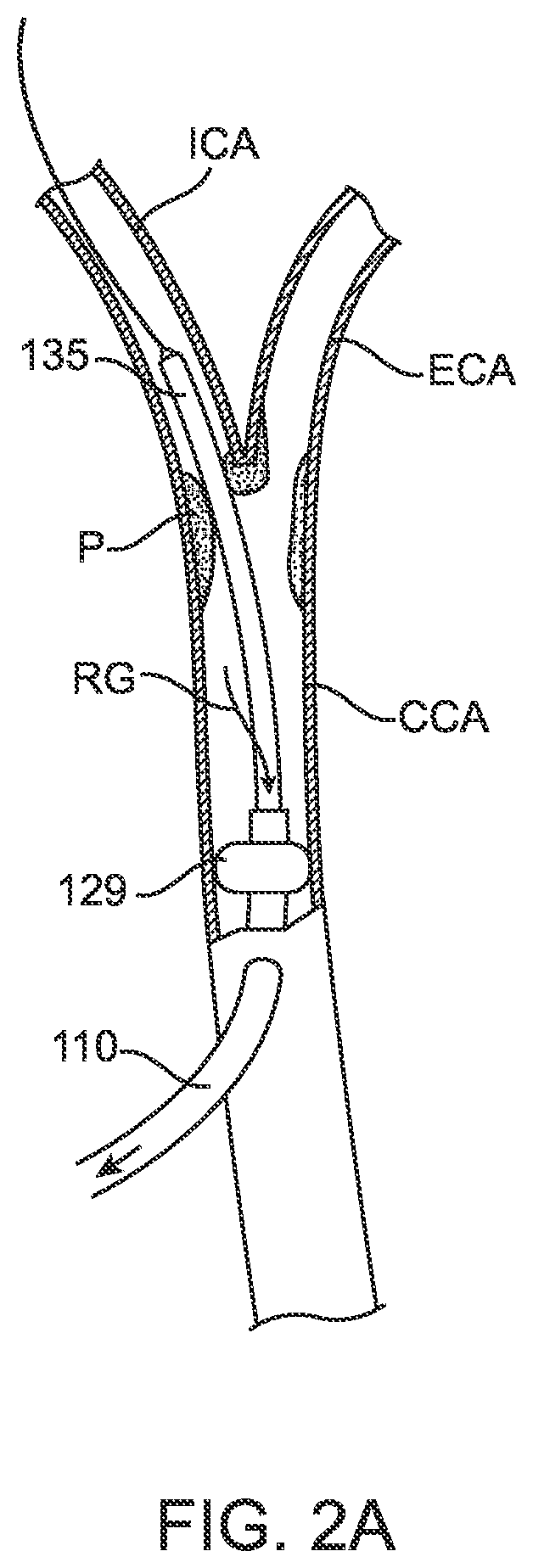 Patent US12396836 Figure 5 – Fenestrated sheath for embolic protection during transcarotid carotid artery revascularization