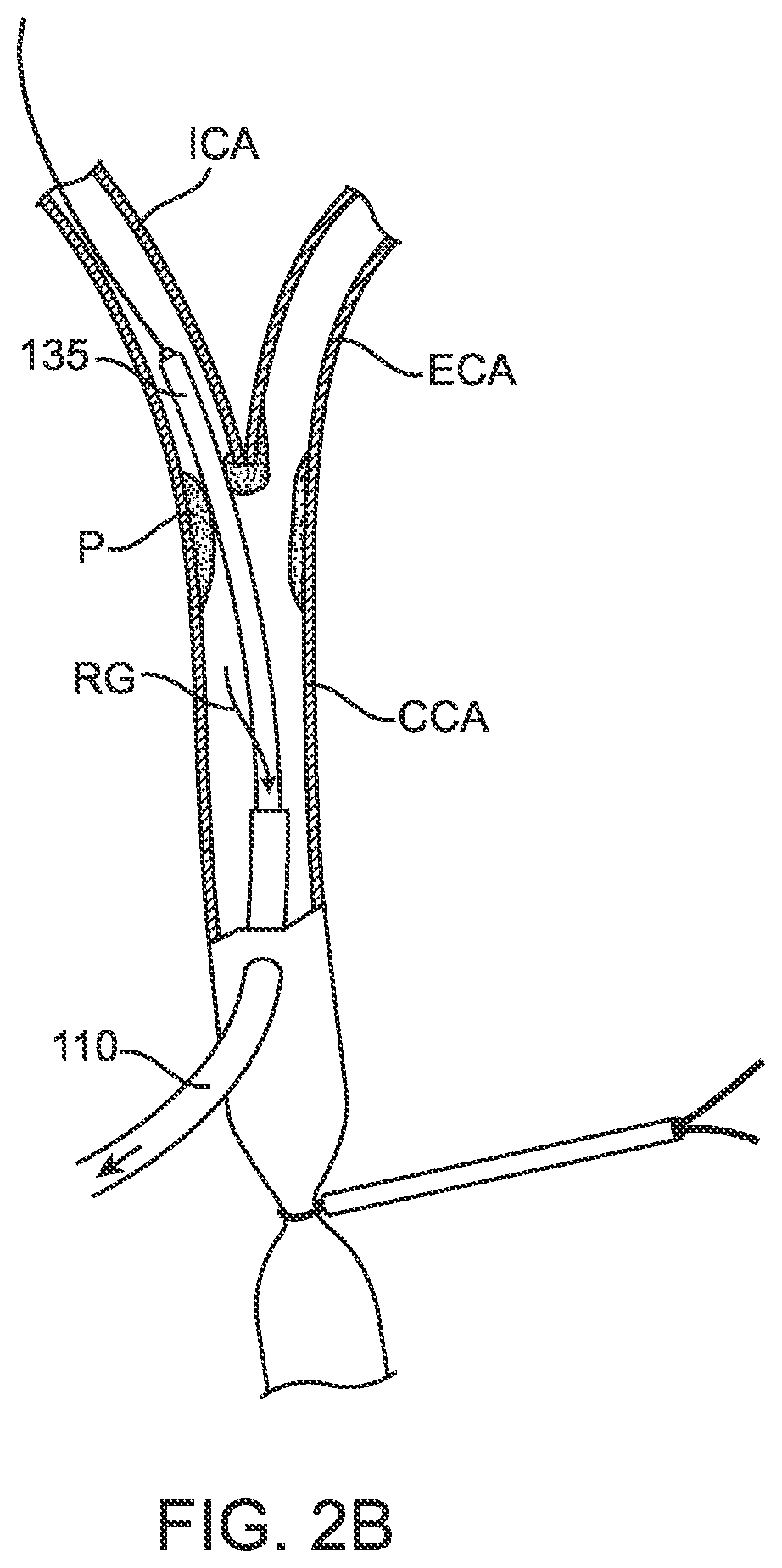 Patent US12396836 Figure 6 – Fenestrated sheath for embolic protection during transcarotid carotid artery revascularization