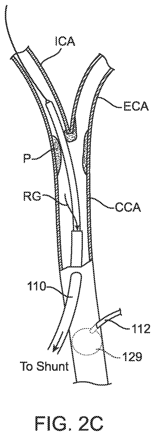 Patent US12396836 Figure 7 – Fenestrated sheath for embolic protection during transcarotid carotid artery revascularization