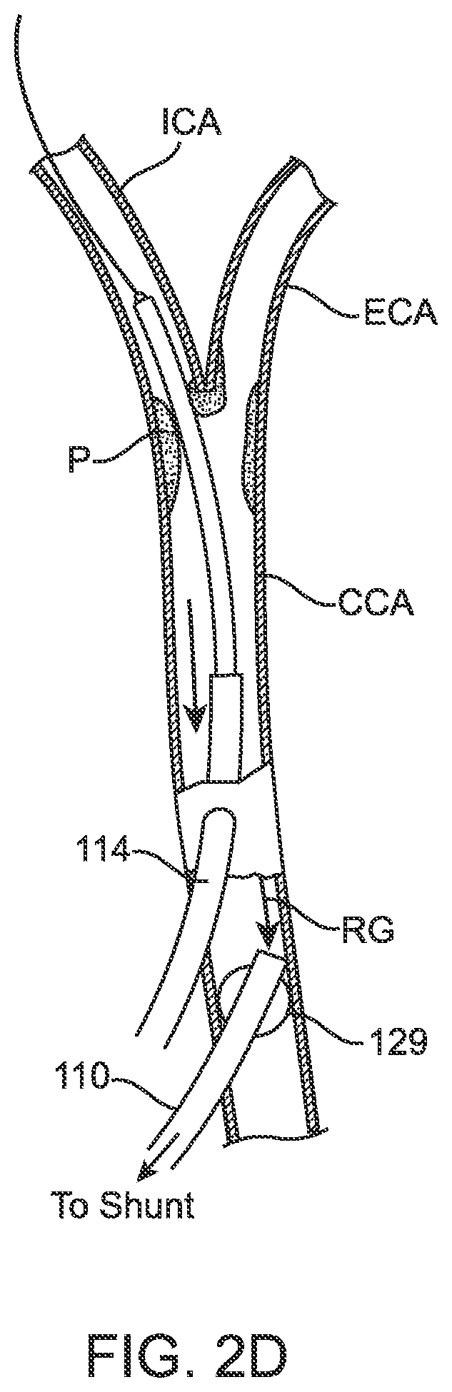 Patent US12396836 Figure 8 – Fenestrated sheath for embolic protection during transcarotid carotid artery revascularization