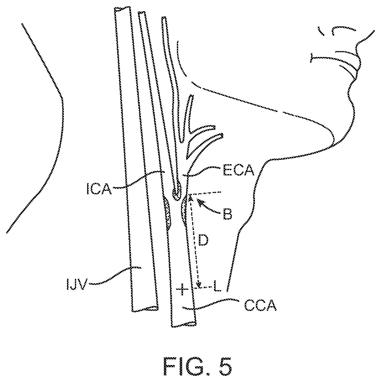 Patent US12396836 Figure 11 – Fenestrated sheath for embolic protection during transcarotid carotid artery revascularization