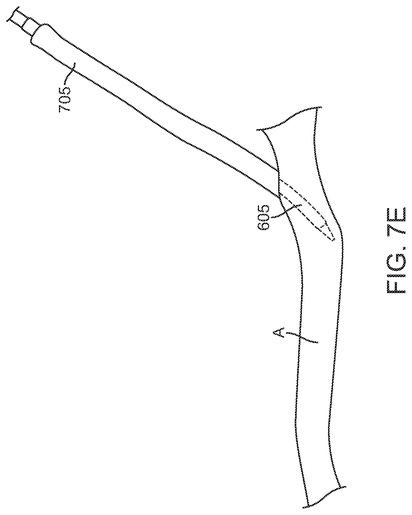 Patent US12396836 Figure 14 – Fenestrated sheath for embolic protection during transcarotid carotid artery revascularization