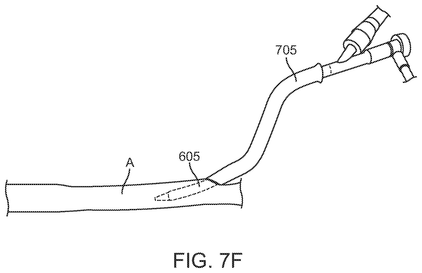 Patent US12396836 Figure 15 – Fenestrated sheath for embolic protection during transcarotid carotid artery revascularization