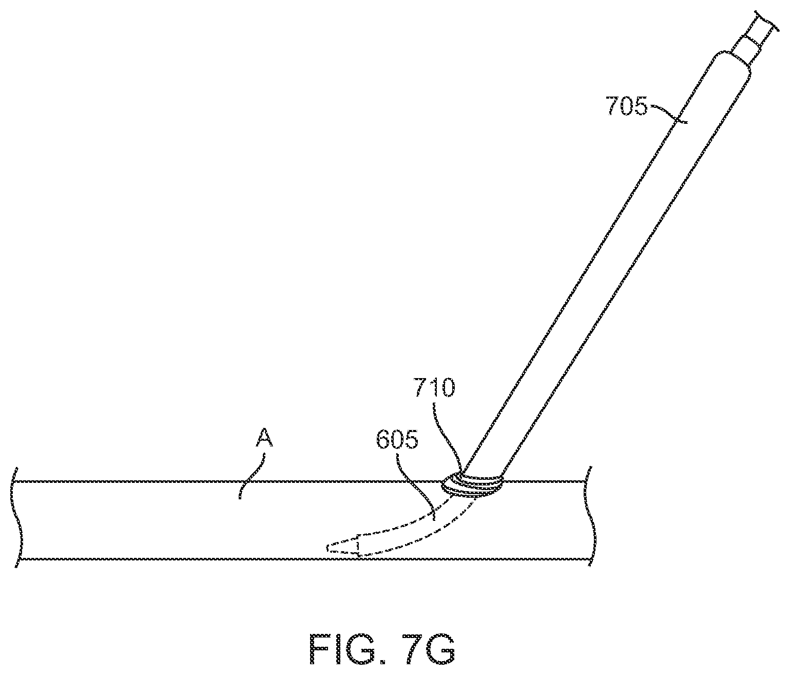 Patent US12396836 Figure 16 – Fenestrated sheath for embolic protection during transcarotid carotid artery revascularization