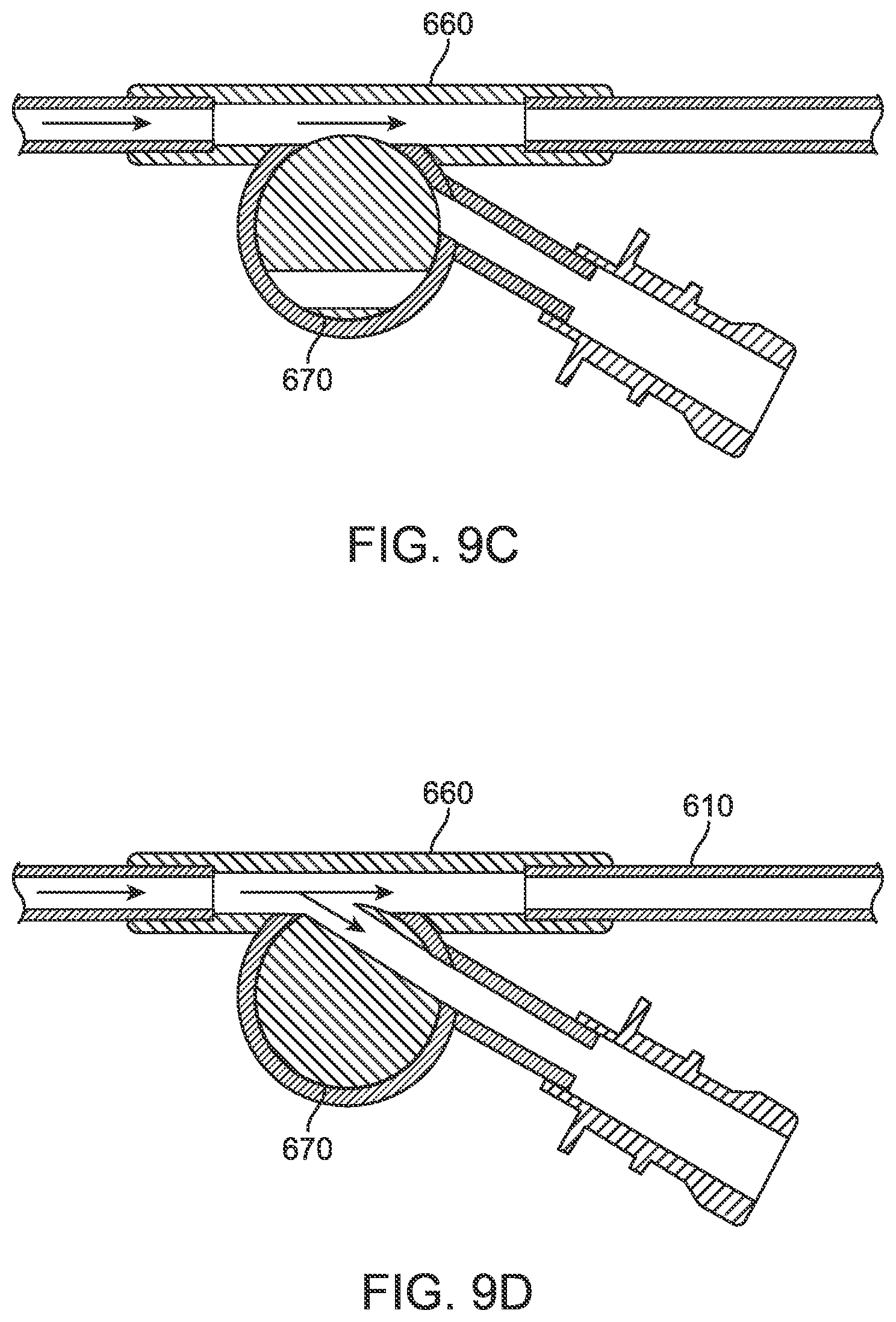 Patent US12396836 Figure 20 – Fenestrated sheath for embolic protection during transcarotid carotid artery revascularization