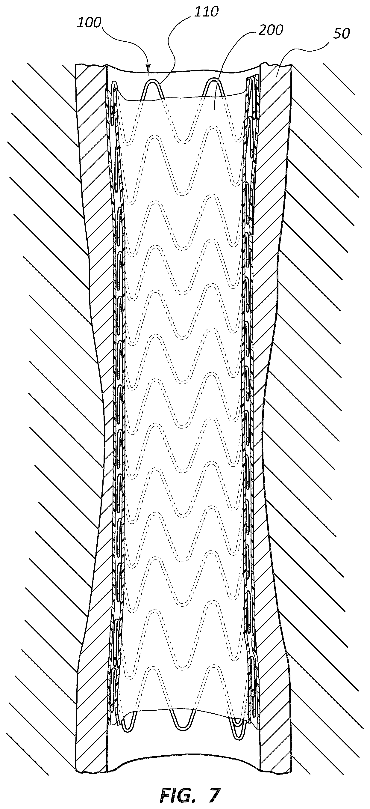 Patent US12396837 Figure 6 – Electrospun PTFE coated stent and method of use