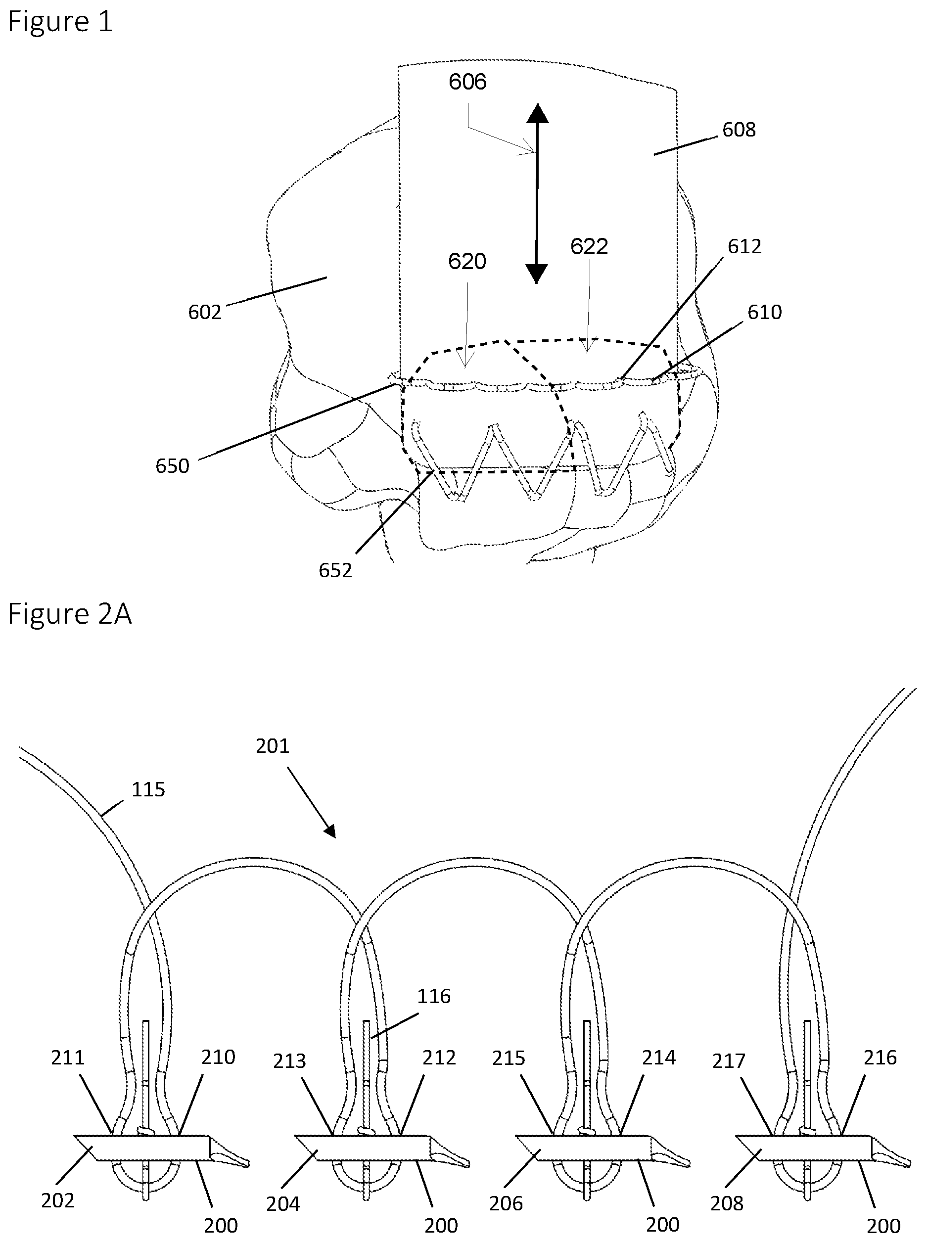Patent US12396839 Figure 1 – Method and apparatus for creating a seam-like anatomical low creep attachment of soft tissue to bone