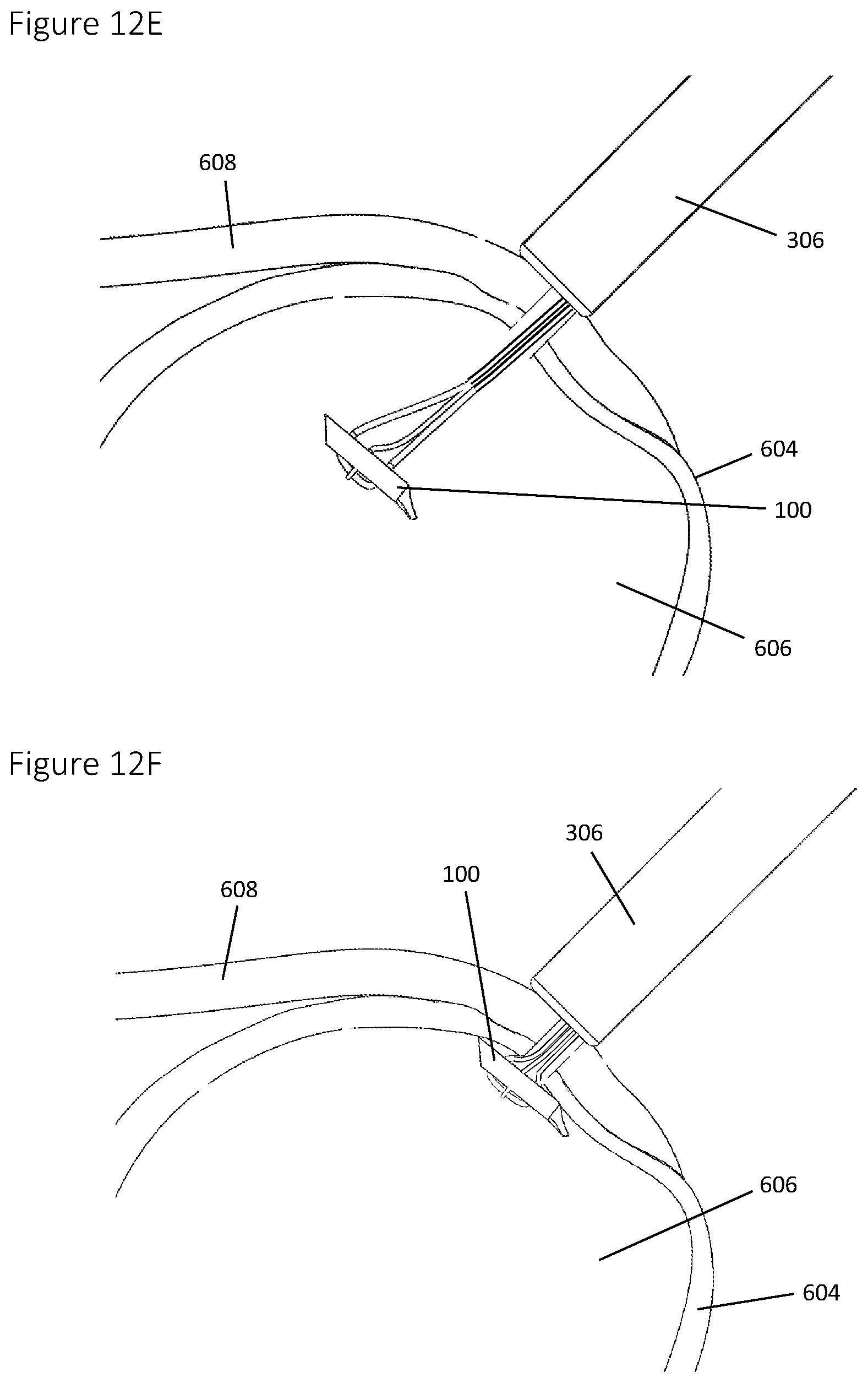 Patent US12396839 Figure 20 – Method and apparatus for creating a seam-like anatomical low creep attachment of soft tissue to bone